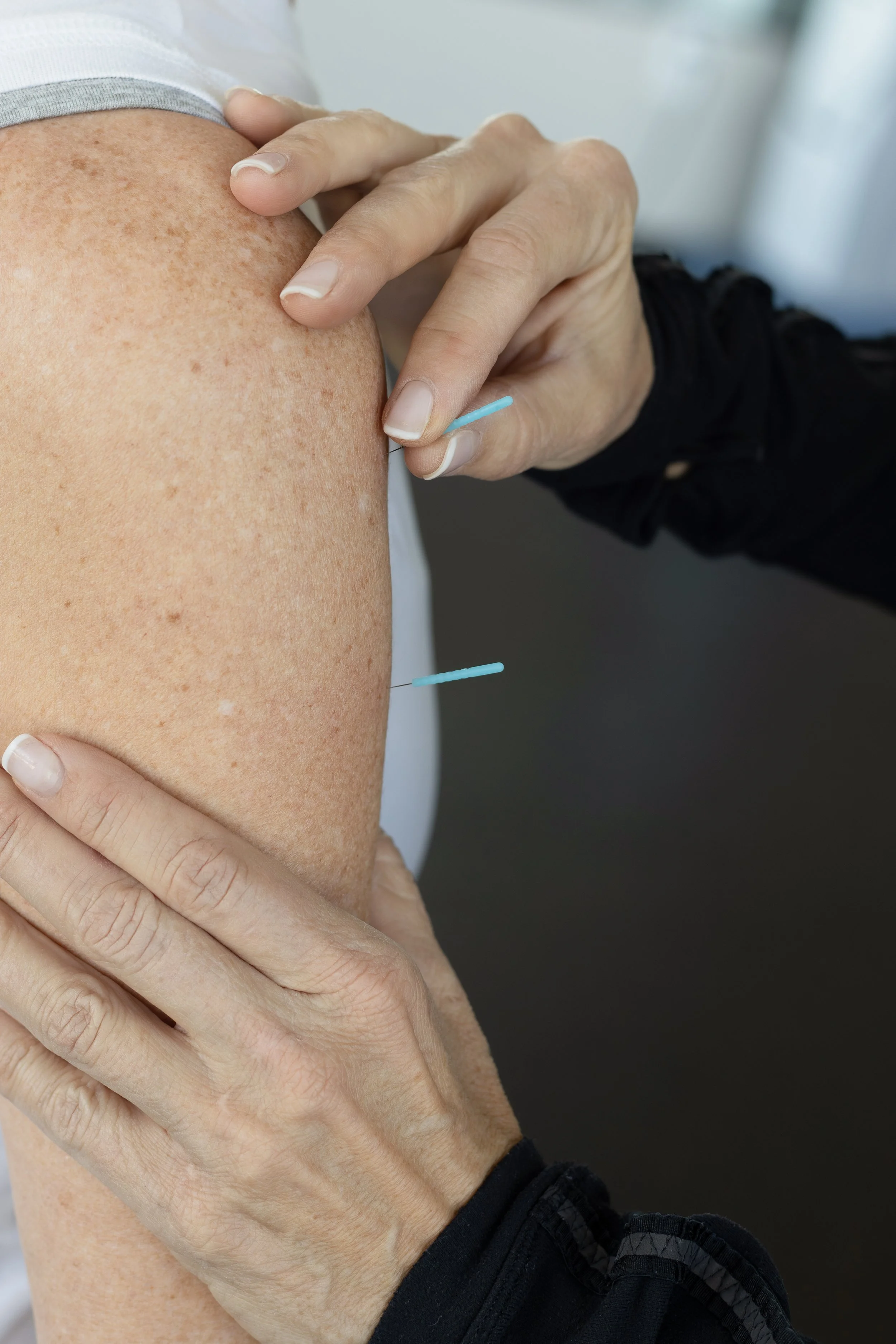 Therapist dry needling a patient's upper arm