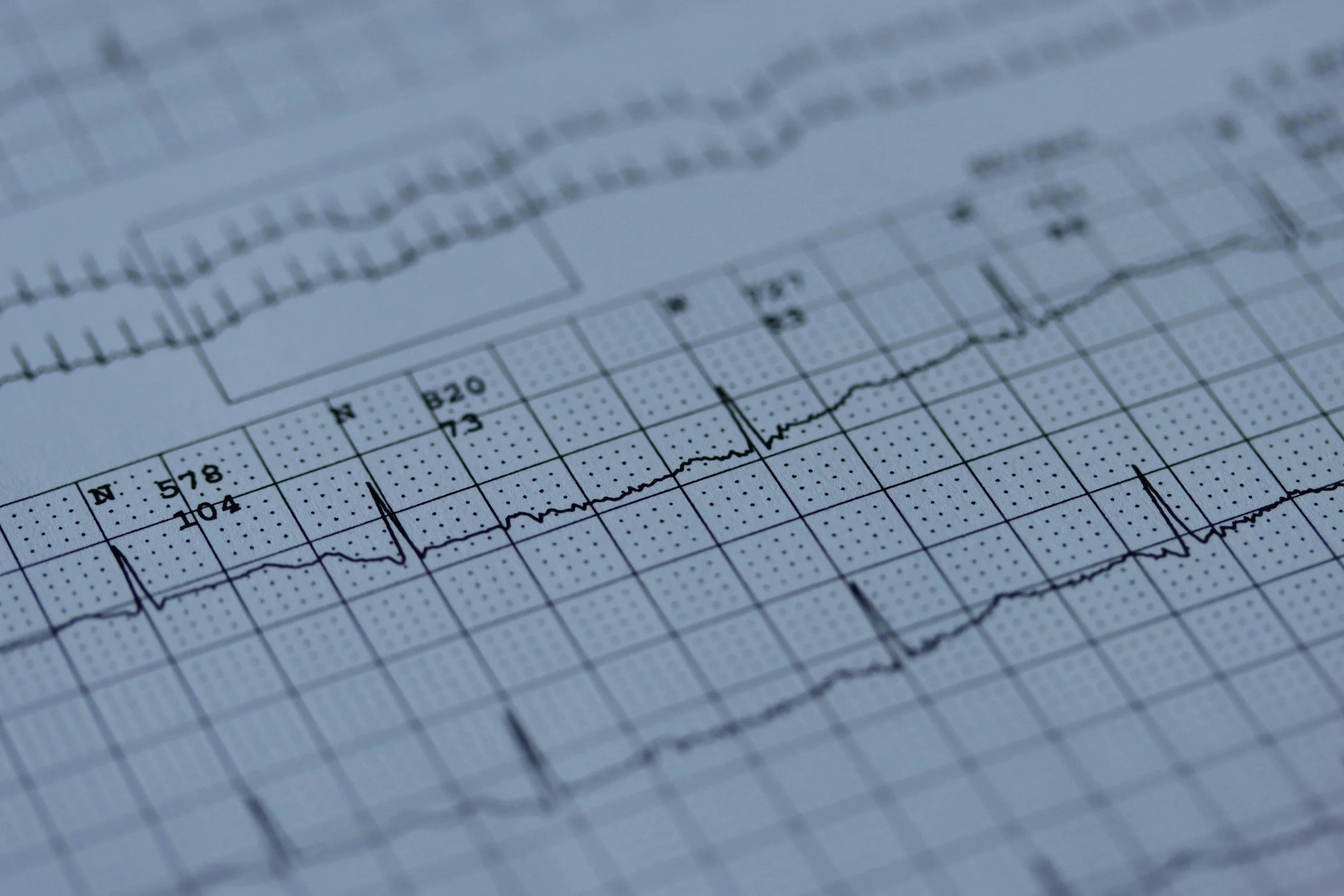 Electrocardiogram (ECG) graph showing heart activity with multiple peaks and valleys on a grid background.