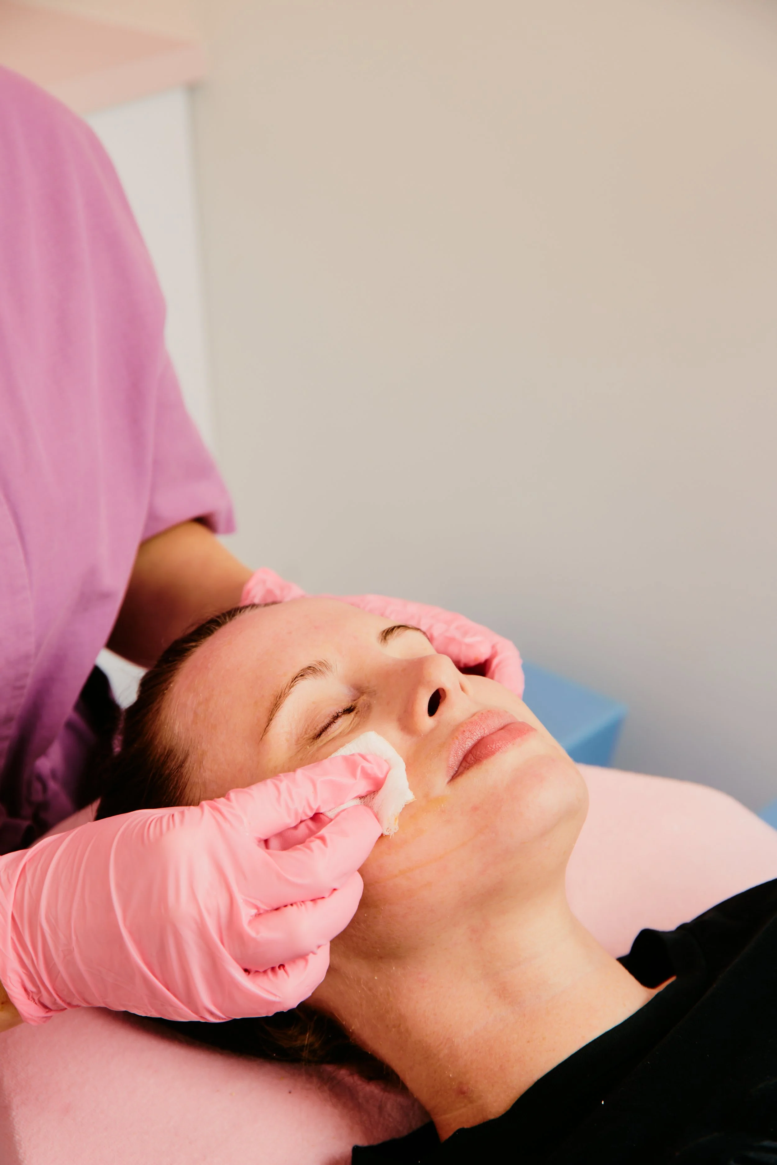 Felicity West Skin Aesthetics Chemical Peel Treatment For Acne, Oily Skin and Skin Rejuvenation