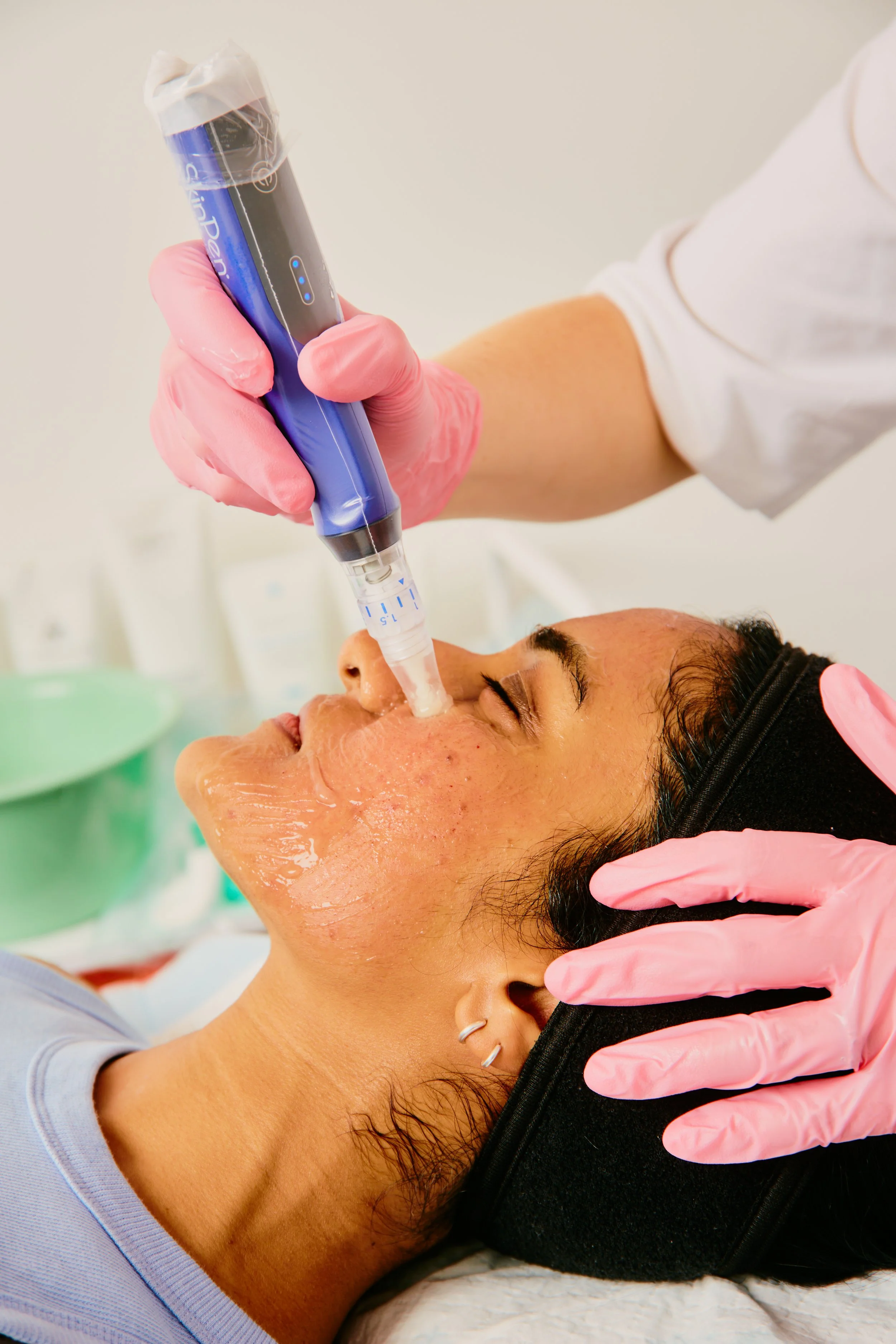 Skin Needling Treatment To Treat Scarring, Acne, Skin Texture And Increase Collagen Production