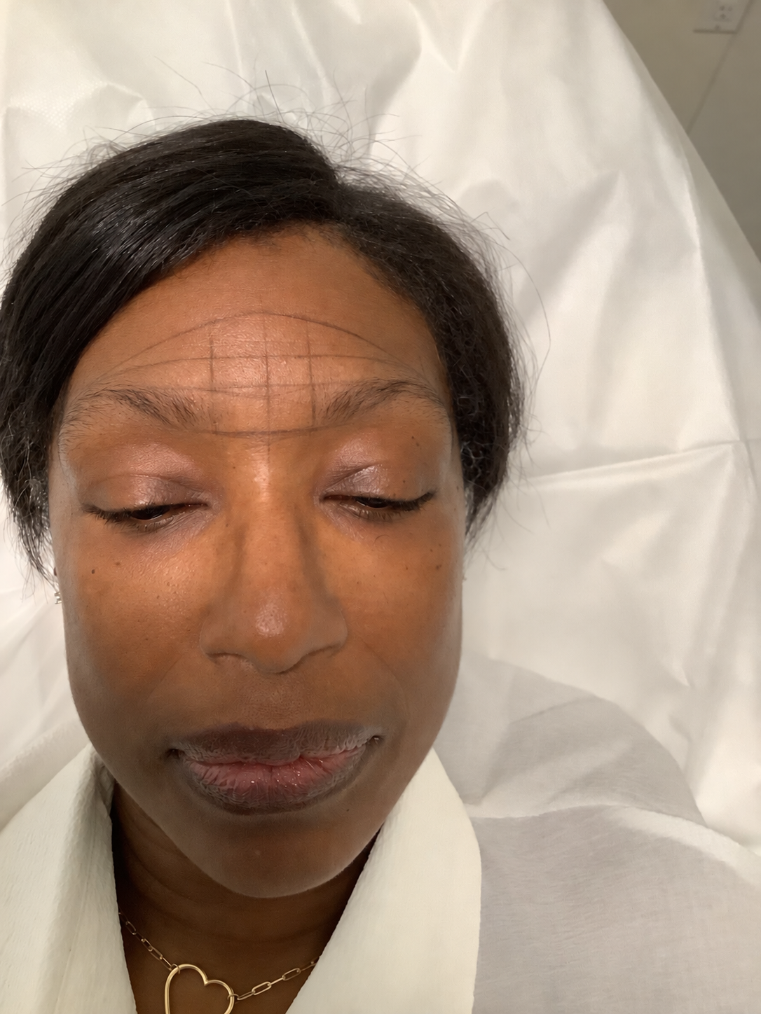 Close-up of a woman lying down with her eyes closed, showing her forehead with pencil markings for a cosmetic procedure, wearing a white top and a heart-shaped necklace.