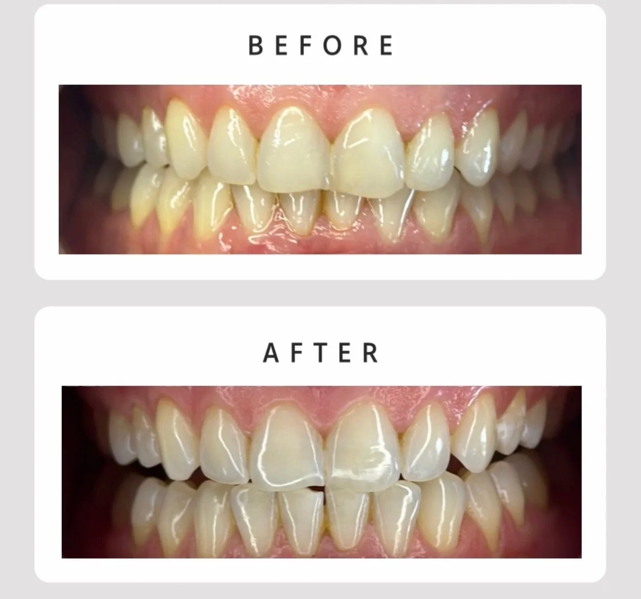 Comparison of teeth before and after whitening or dental treatment, showing improved appearance in the after image.