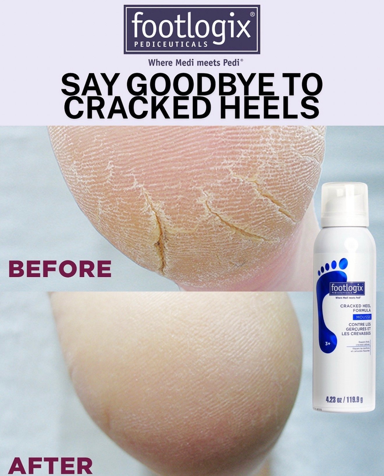 A comparison of a cracked heel before and after using footlogix heel repair foam, showing smoother skin after treatment.