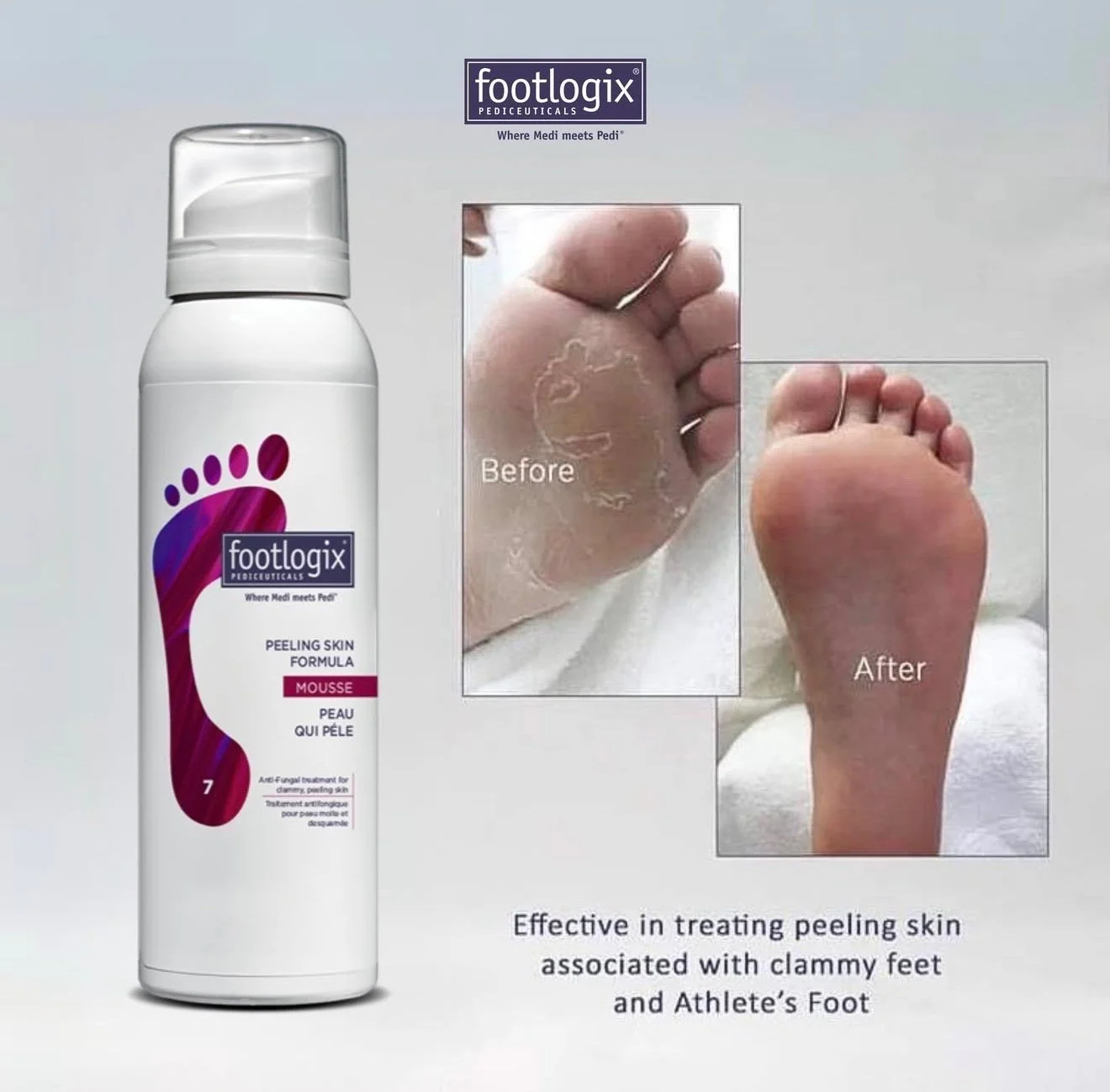 Footlogix peeling skin foam product with before and after images of a foot showing dead skin removal and smooth skin, along with text noting its effectiveness for treating peeling skin on feet and heels.