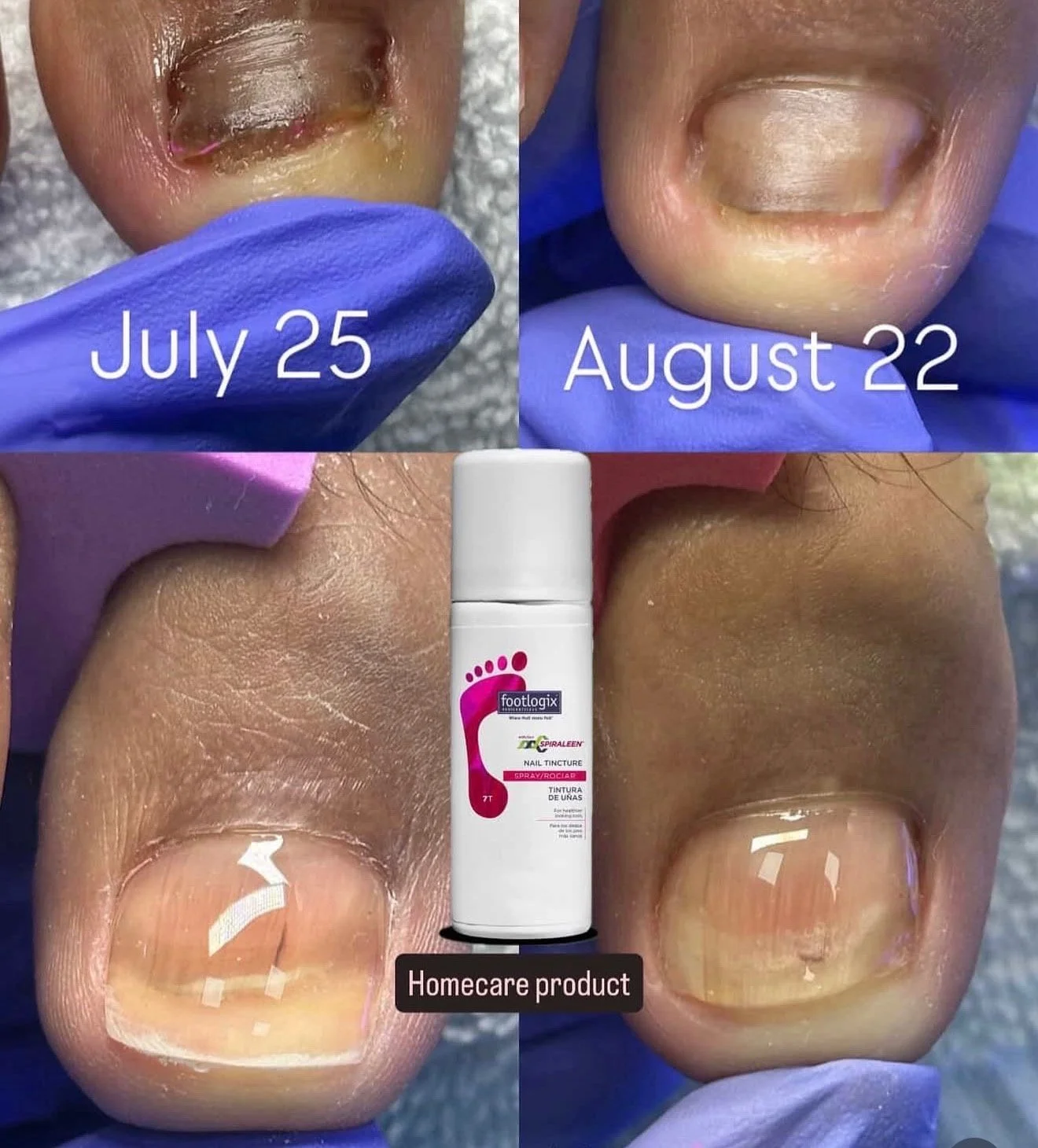 Sequence of four close-up photos showing the healing process of a toenail fungus or injury from July 25 to August 22, with a foot care product bottle in the center labeled footlogix nail tincture, applied as homecare.