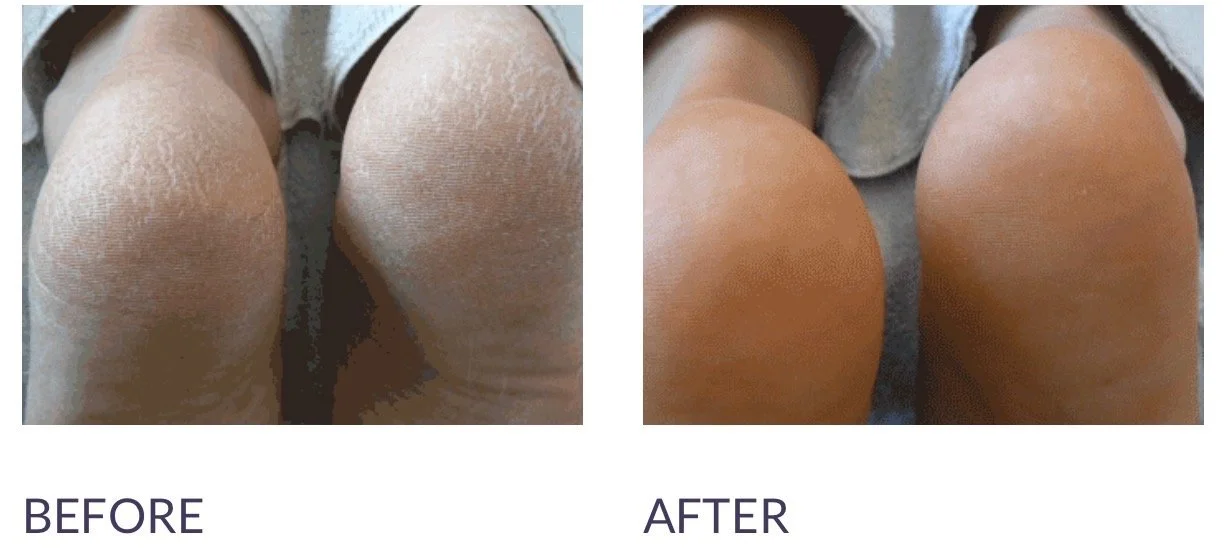 Comparison of the backs of two knees, showing dry, flaky skin in the 'before' image and smooth, moist skin in the 'after' image.