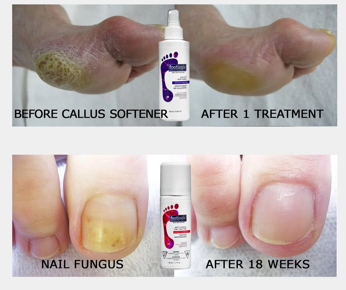 Comparison of foot and toenail health showing before and after treatment. The top image shows a foot with callus softener applied, and the bottom image shows a toenail with nail fungus before and after 18 weeks of treatment.
