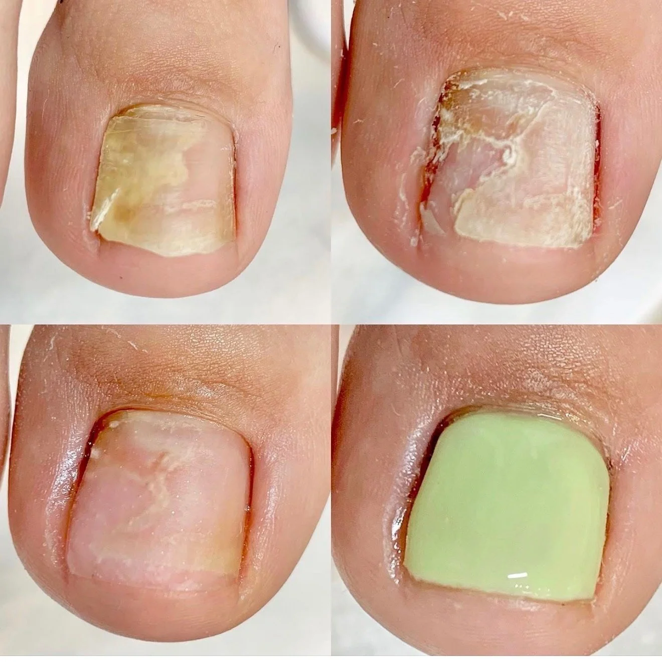 Progression of nail treatment showing a damaged, discolored, and peeling fingernail in the top images, and a healthy, painted, and restored nail in the bottom right image.