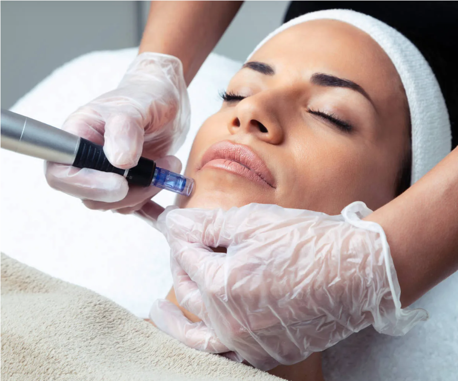 A woman receiving a facial treatment with a micro-needling device, lying with eyes closed, in a spa or clinic setting.