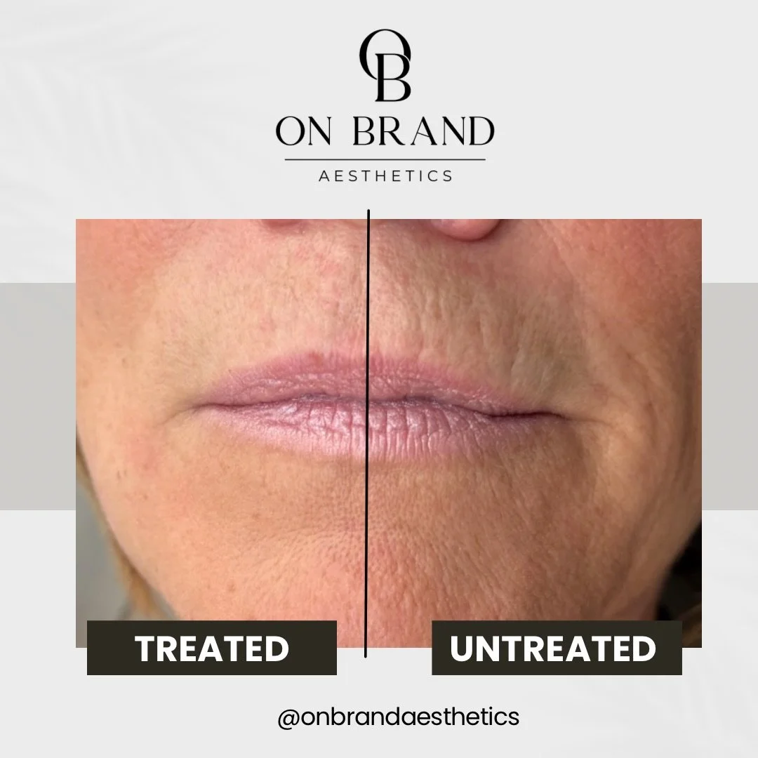 There&rsquo;s a difference between chasing lines and highlighting natural structure.

The treated side result was achieved with &frac12; syringe of RHA2 strategically placed to restore balance to the lower face.

We softened her &ldquo;smoker&rsquo;s