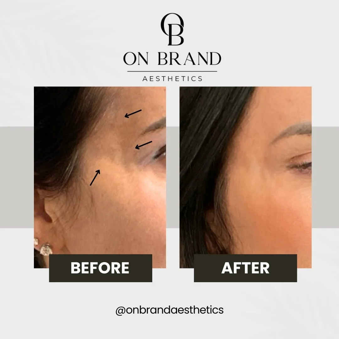 Not every transformation has to be dramatic to be powerful.

Filler, when placed strategically, isn&rsquo;t about changing your face.. it&rsquo;s about restoring what time has quietly taken. As we age, we lose volume in key areas that once gave us st