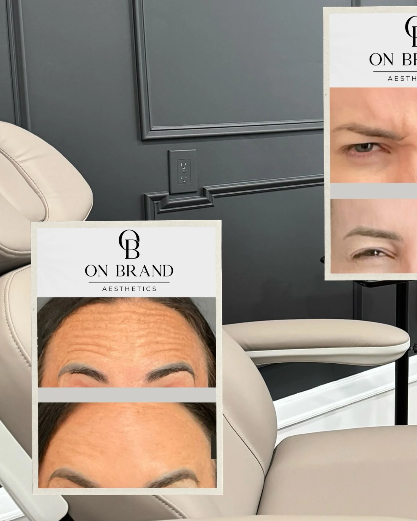 Before &amp; Afters: still you, just a little more refreshed

Neurotoxins aren&rsquo;t about changing your face&hellip; they&rsquo;re about softening what no longer reflects how vibrant you feel. Strategic treatment can help relax unwanted lines, pre