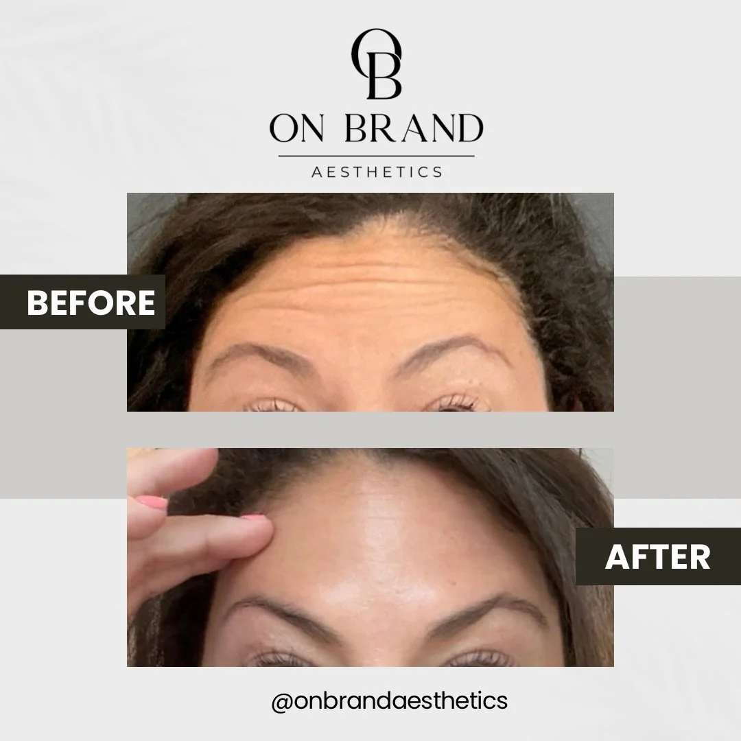 Can we also take a moment for the Daxxify glow.. because WOW!

This is exactly why tox shouldn&rsquo;t get the reputation it does.
When done thoughtfully, it doesn&rsquo;t change your features, it enhances them. You still look like YOU&hellip; just m