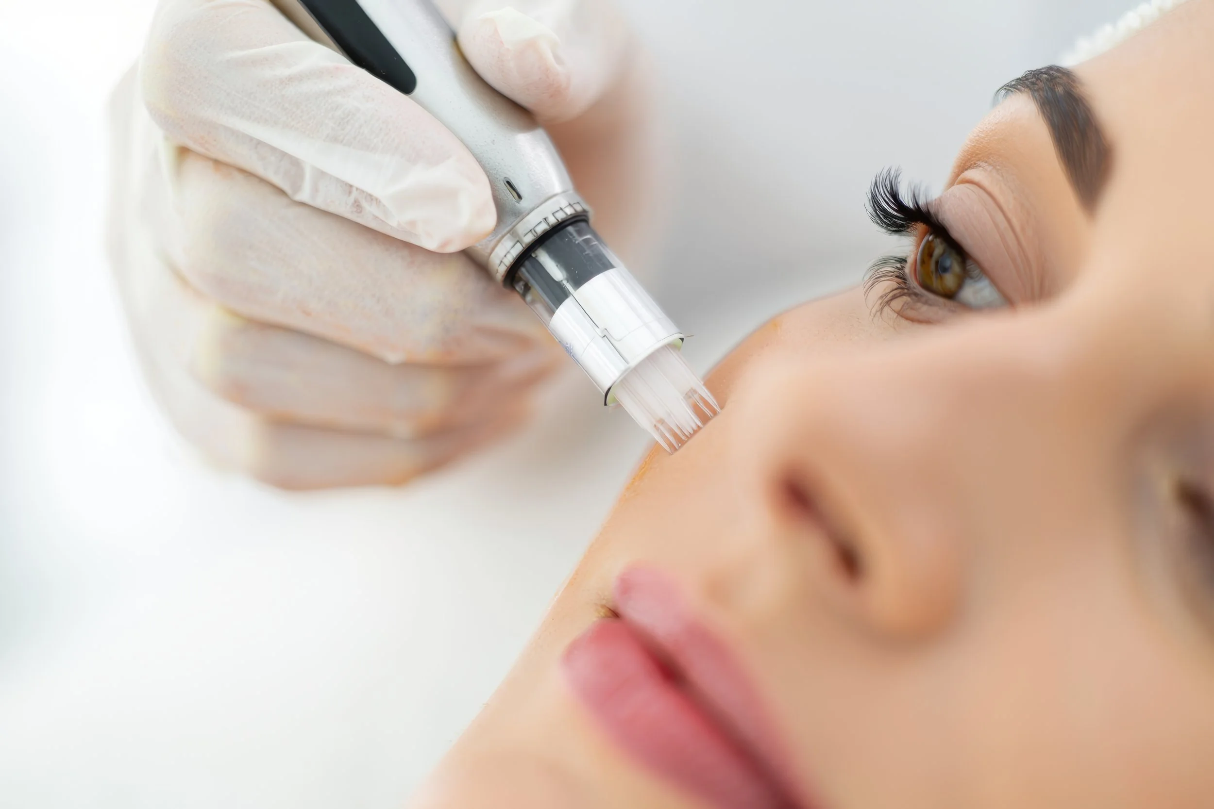 A woman receiving a facial treatment with a syringe device near her nose, close-up of her face and eyes.