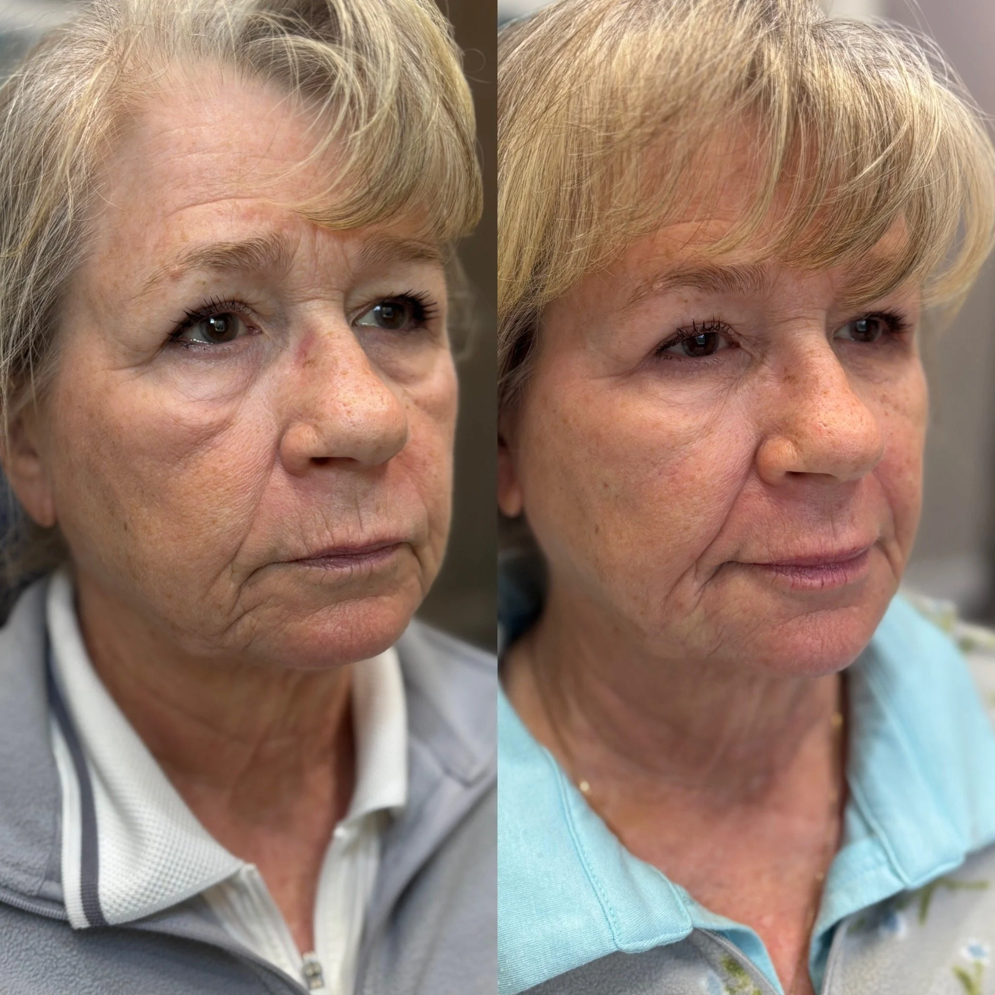 Side-by-side comparison of a middle-aged woman before and after a cosmetic treatment, showing improvements in skin texture and appearance.