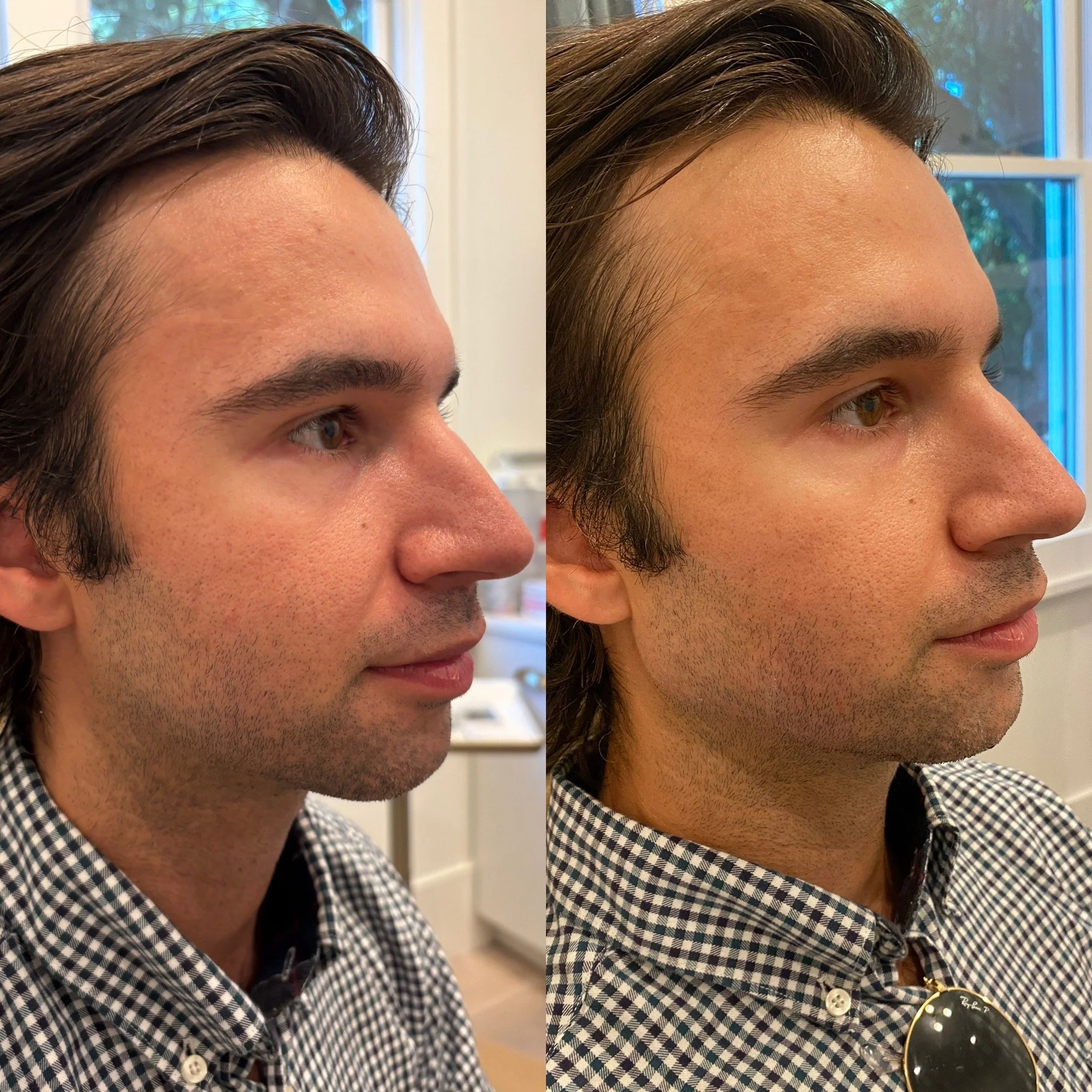 Side-by-side comparison of a young man's face before and after a cosmetic procedure, with the 'before' showing a slightly rougher skin texture and the 'after' appearing smoother.