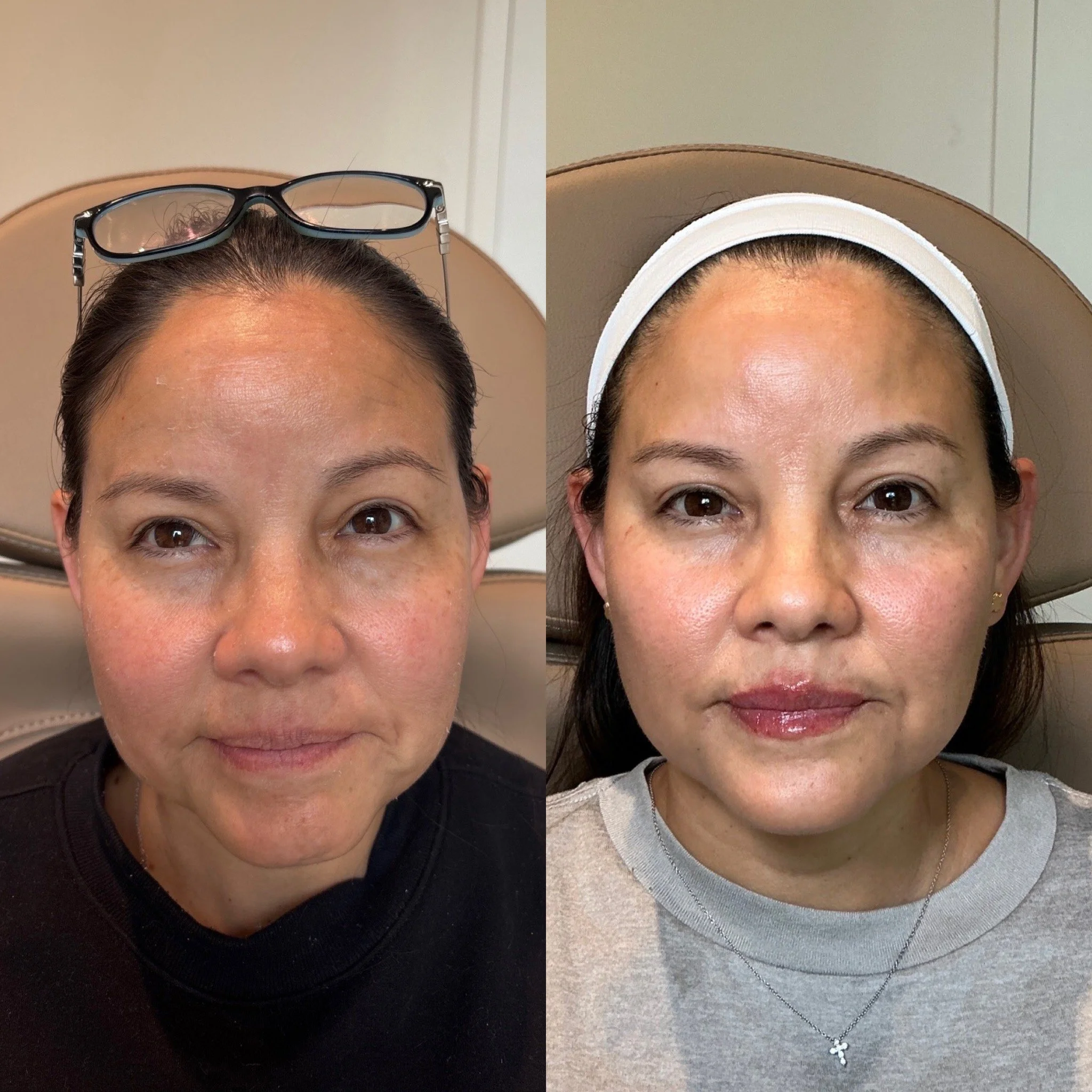 Side-by-side comparison of a woman before and after a skincare treatment, showing clearer and more radiant skin in the after photo.