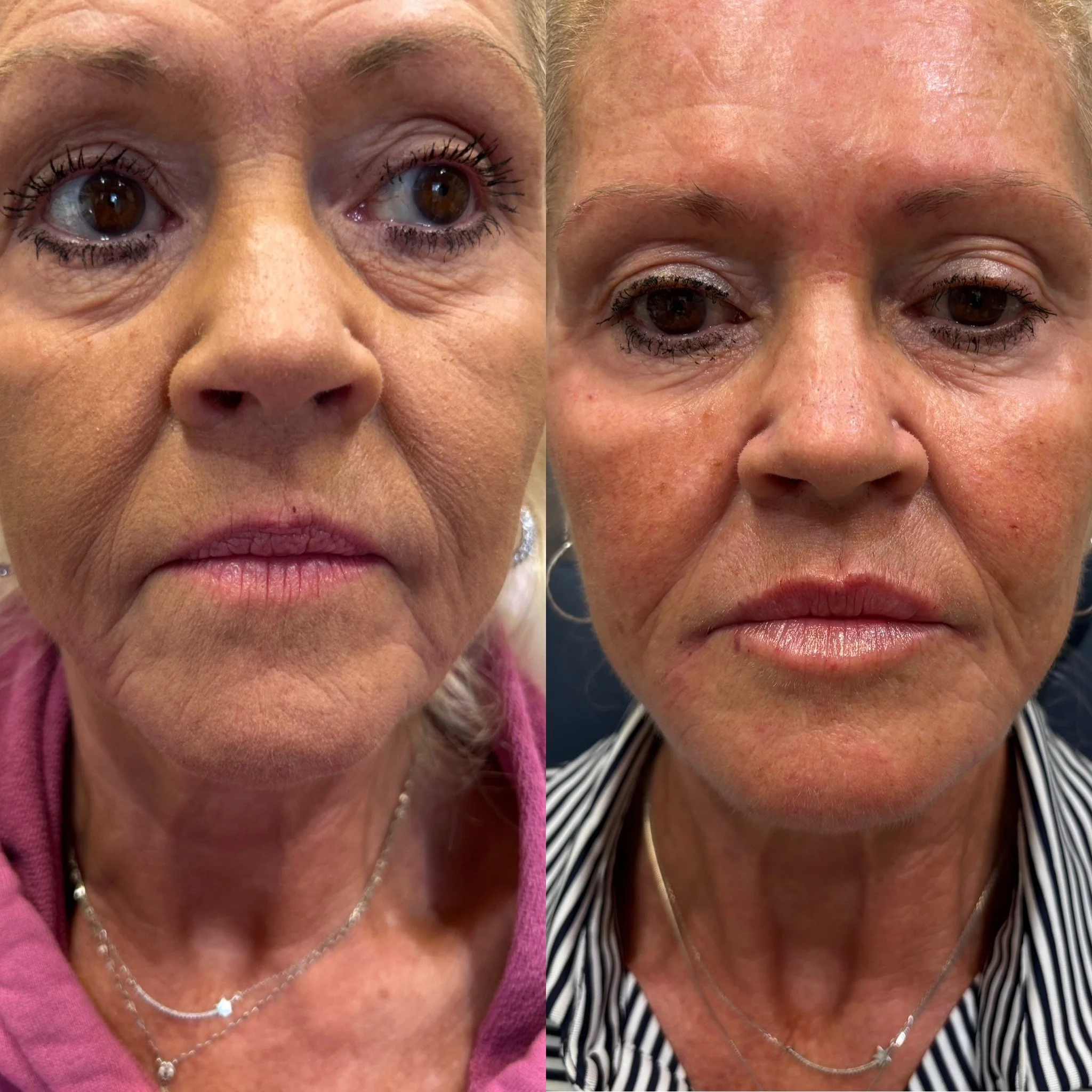 Side-by-side close-up images of a middle-aged woman's face showing before and after facial treatment, with visible skin improvements.