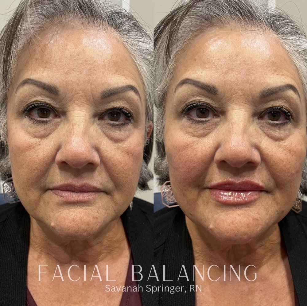 Before and after photos showing facial balancing treatment on a woman, with visible improvements in skin appearance and facial symmetry.