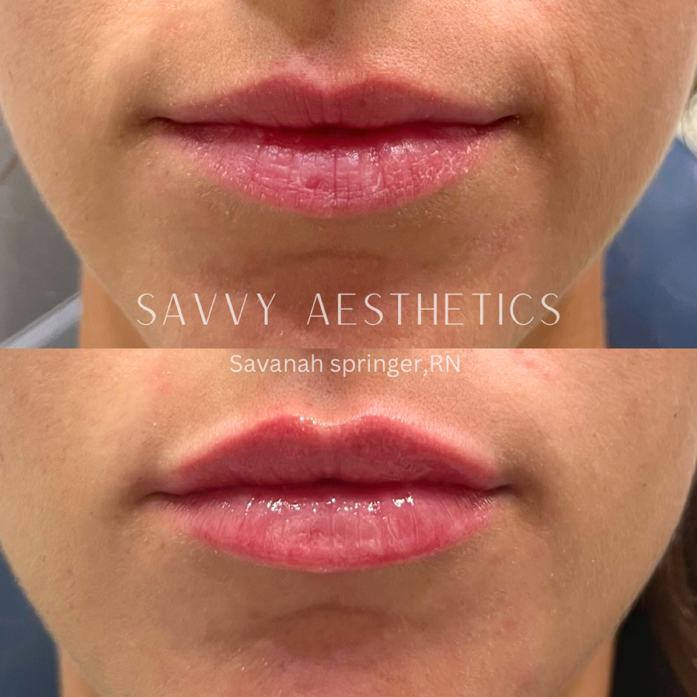 Close-up image showing before and after photos of lips, with the after photo displaying fuller, glossier lips with enhanced shape and definition. Text overlays indicate the work was done by Savannah Springer, RN, for Savvy Aesthetics.