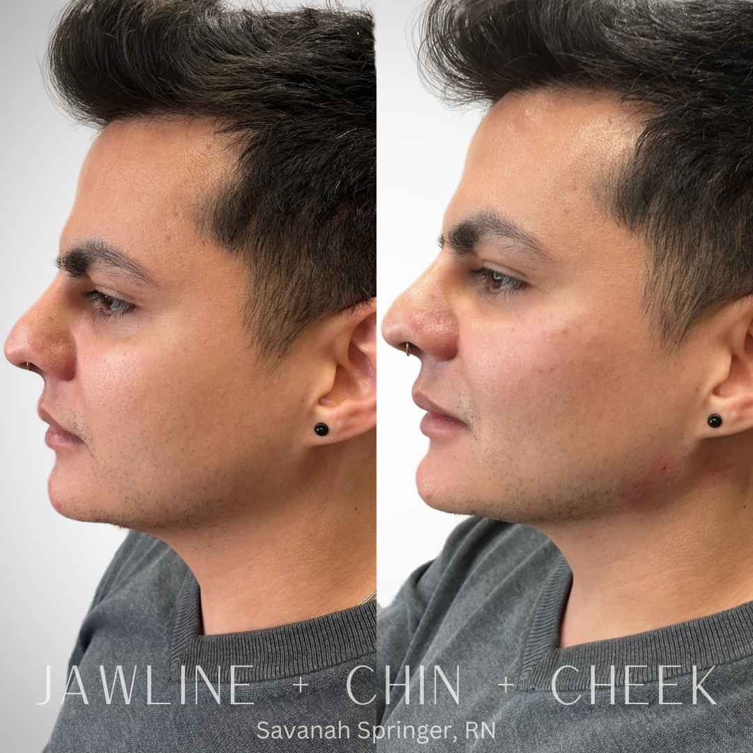 Side-by-side comparison of a man's face before and after a cosmetic procedure focusing on the jawline, chin, and cheek area, with text overlay listing the treated areas and credit to Savannah Springer, RN.