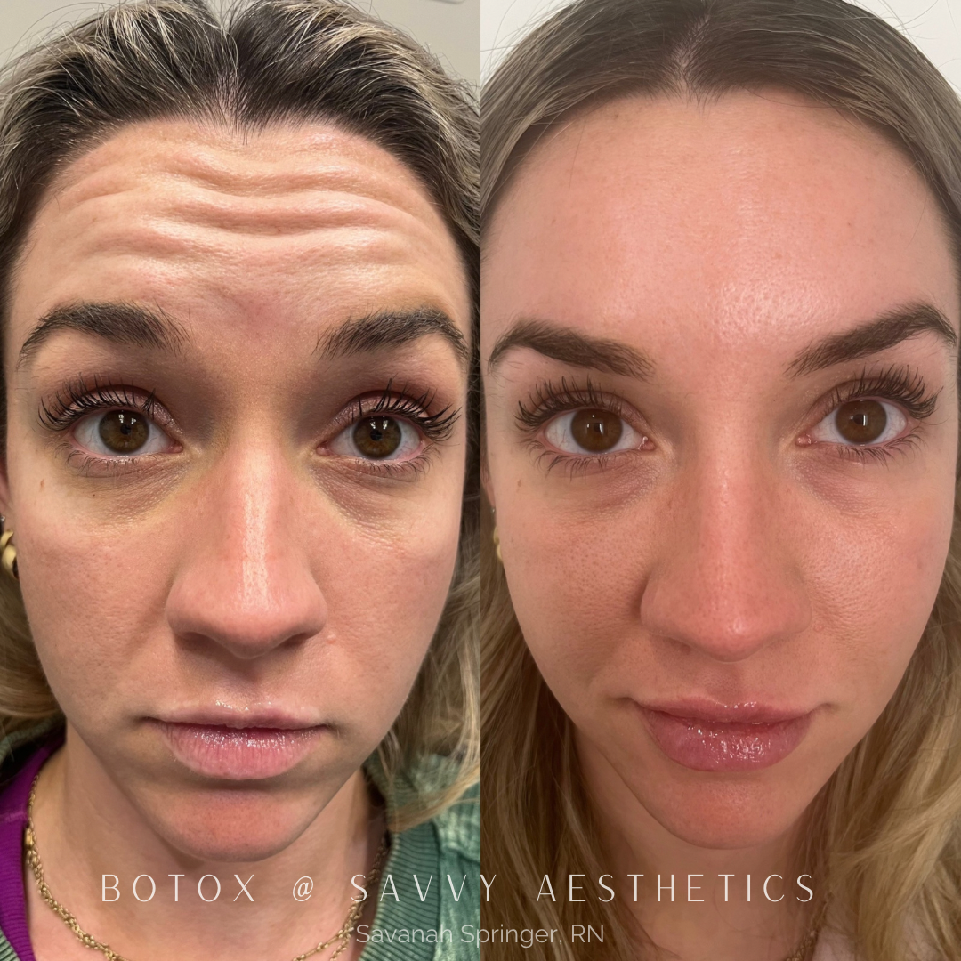Before and after photos of a woman showing the effects of Botox treatment, with reduced forehead wrinkles in the after photo.