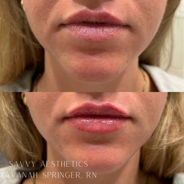 Close-up of a woman's lips, showing a before and after of lip enhancement treatment. The after image displays fuller, more defined lips with a glossy finish.