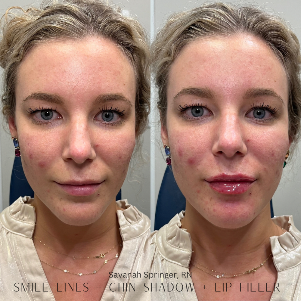 Before and after images of a woman showing results of smile lines, chin shadow, and lip filler treatments, with the second photo displaying smoother skin and slightly fuller lips.