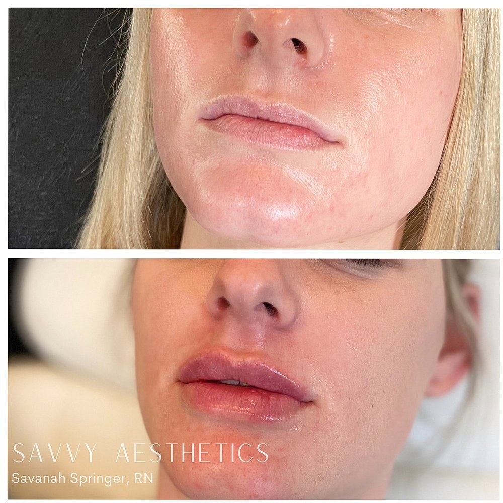 Close-up of a woman's face before and after cosmetic lip enhancement, showing fuller, more defined lips in the after image, with text overlay 'Savvy Aesthetics, Savannah Springer, RN'.