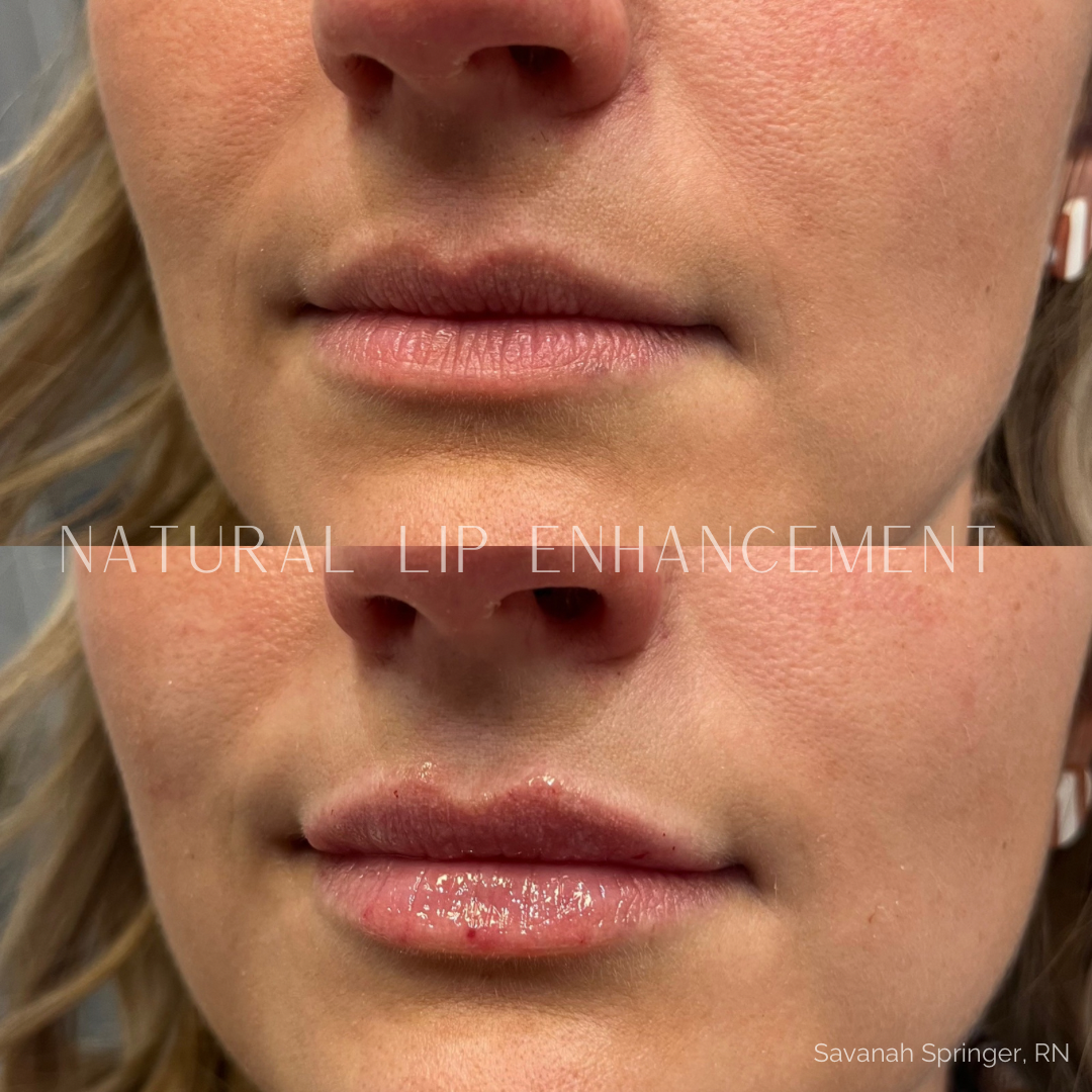Close-up comparison of a woman's lips before and after natural lip enhancement, showing fuller, glossier lips in the after image.