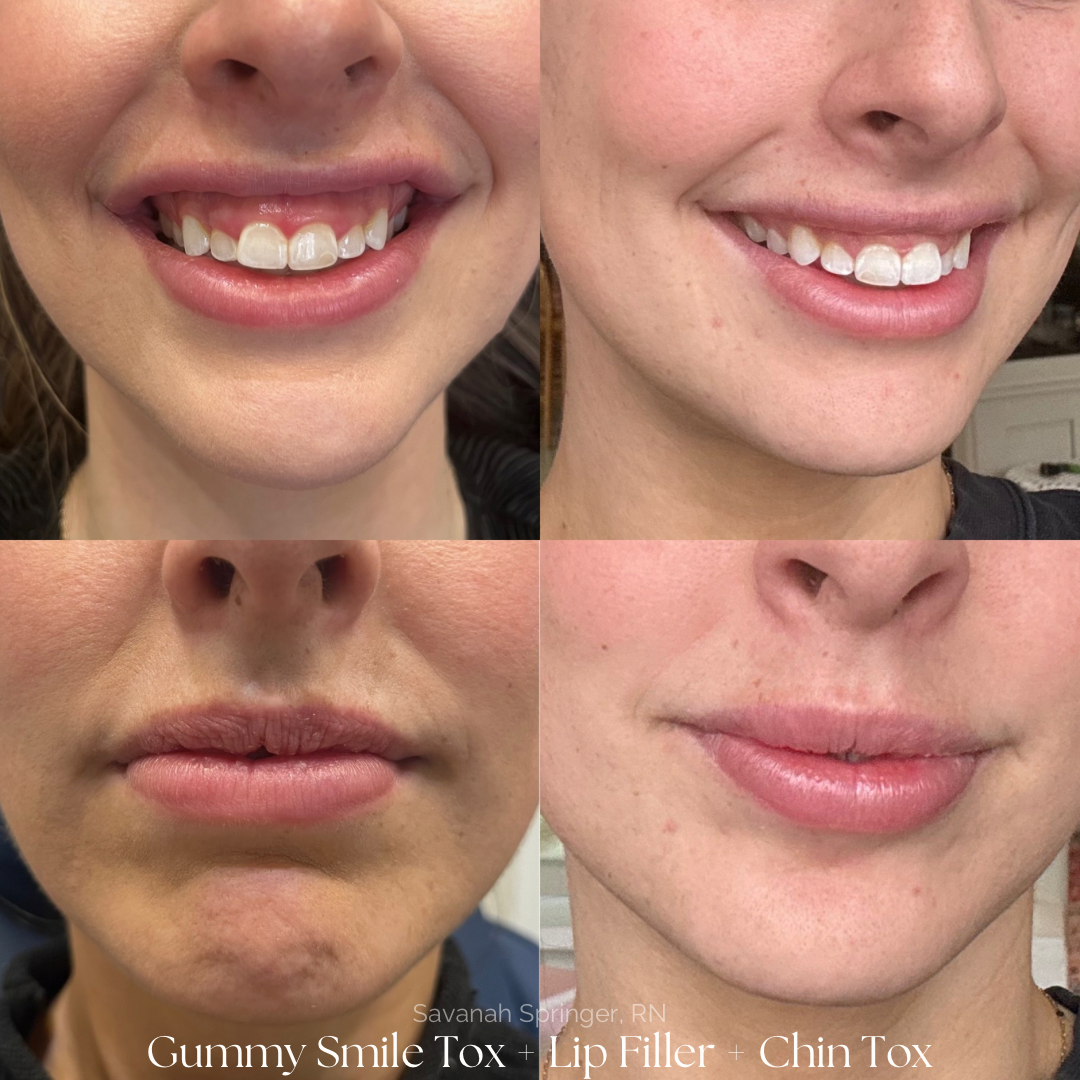 Before and after photos of a woman showing improvements after gummy smile Botox, lip filler, and chin toxin treatments. Top left shows a gummy smile before treatment; top right shows a smile after treatment; bottom left shows lips before filler; bott