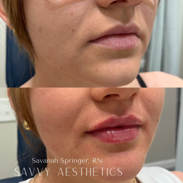 Before and after photos of a woman's face showing improved skin and full lips, with text overlay crediting Savannah Springer, RN, from Savvy Aesthetics.
