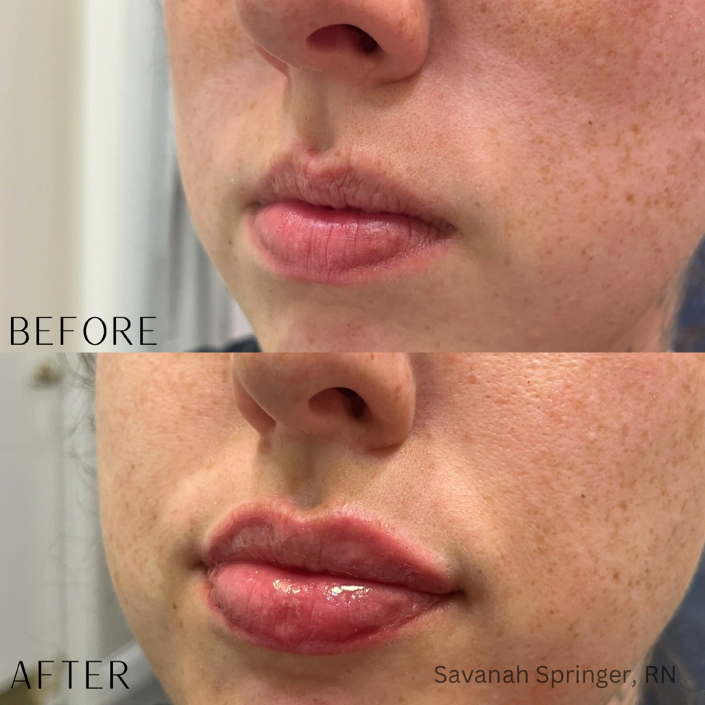 Close-up images of a person's lips before and after cosmetic lip enhancement showing fuller and glossier lips in the after photo.
