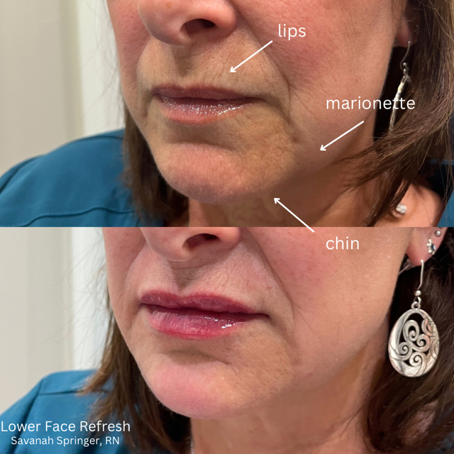 Before and after images of a woman's lower face showing improvements. The top image shows her lips, marionette lines, and chin with visible wrinkles and sagging. The bottom image shows smoother, more lifted skin with fewer wrinkles, indicating a cosm