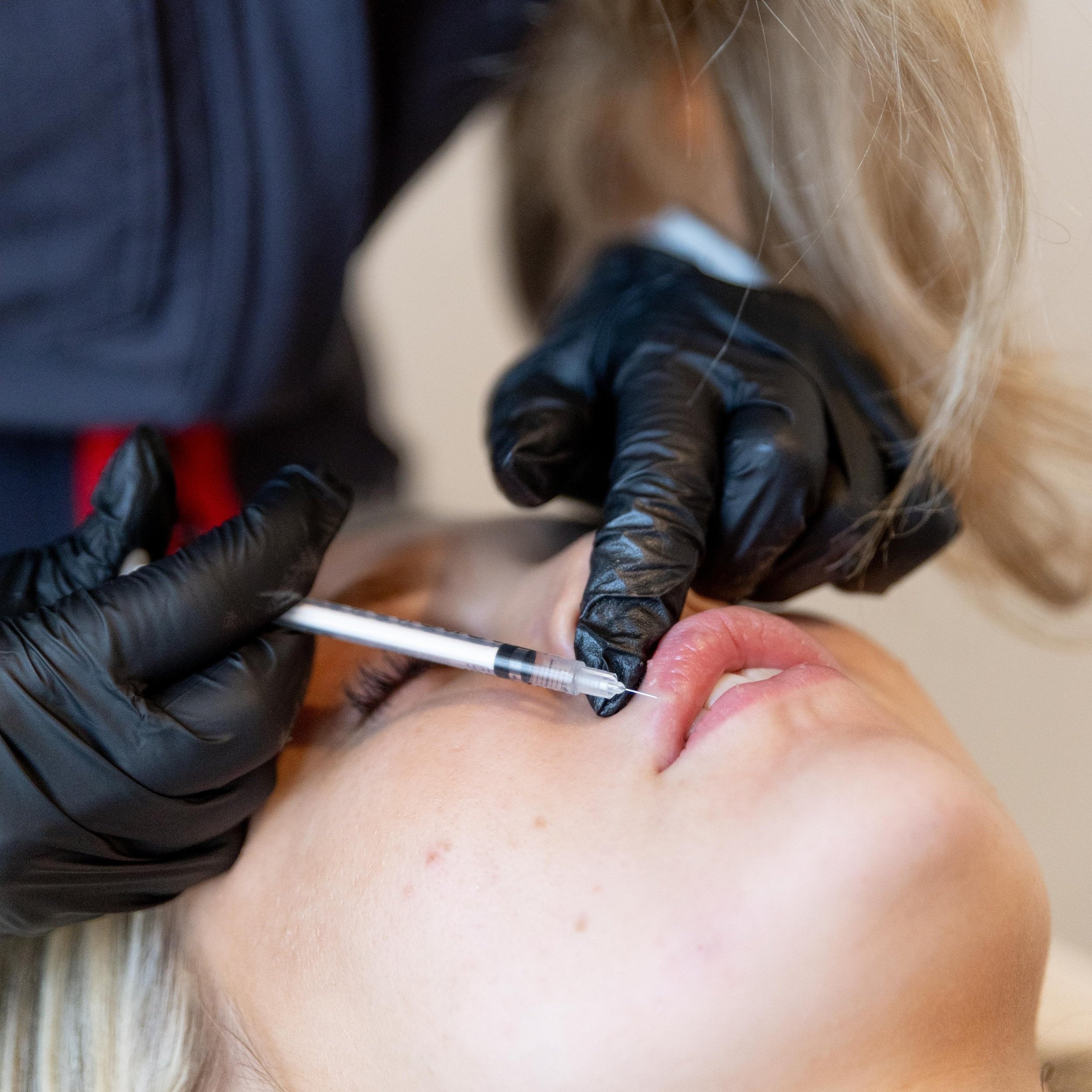 A person receiving a cosmetic lip injection while lying down, with a healthcare professional using a syringe. The healthcare worker wears black gloves and has blonde hair.