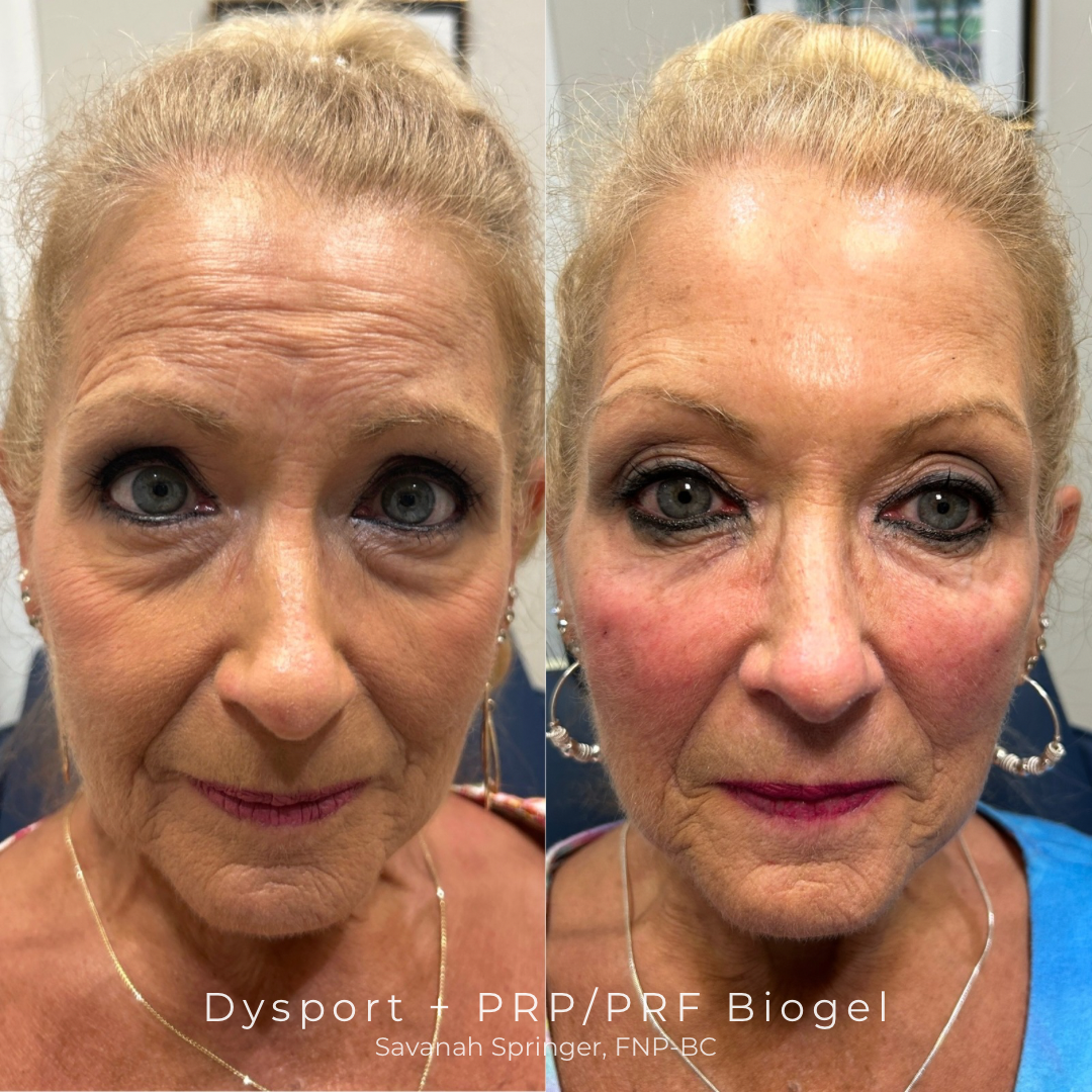Dysport + PRPPRF Biogel.PNG