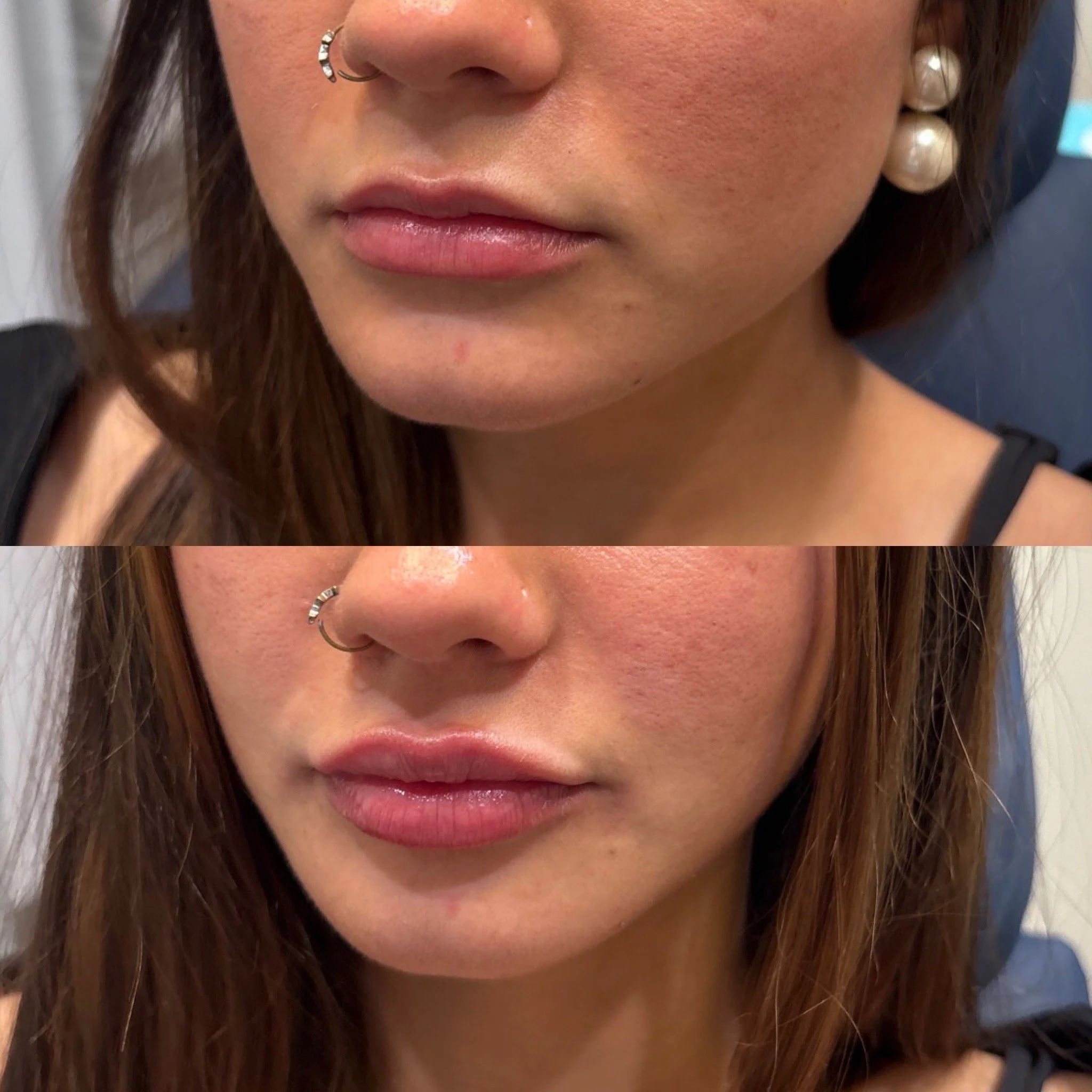 Close-up of a young woman’s face showing a before-and-after comparison of skin treatment. Top: skin with redness and blemishes. Bottom: clearer skin with reduced redness.