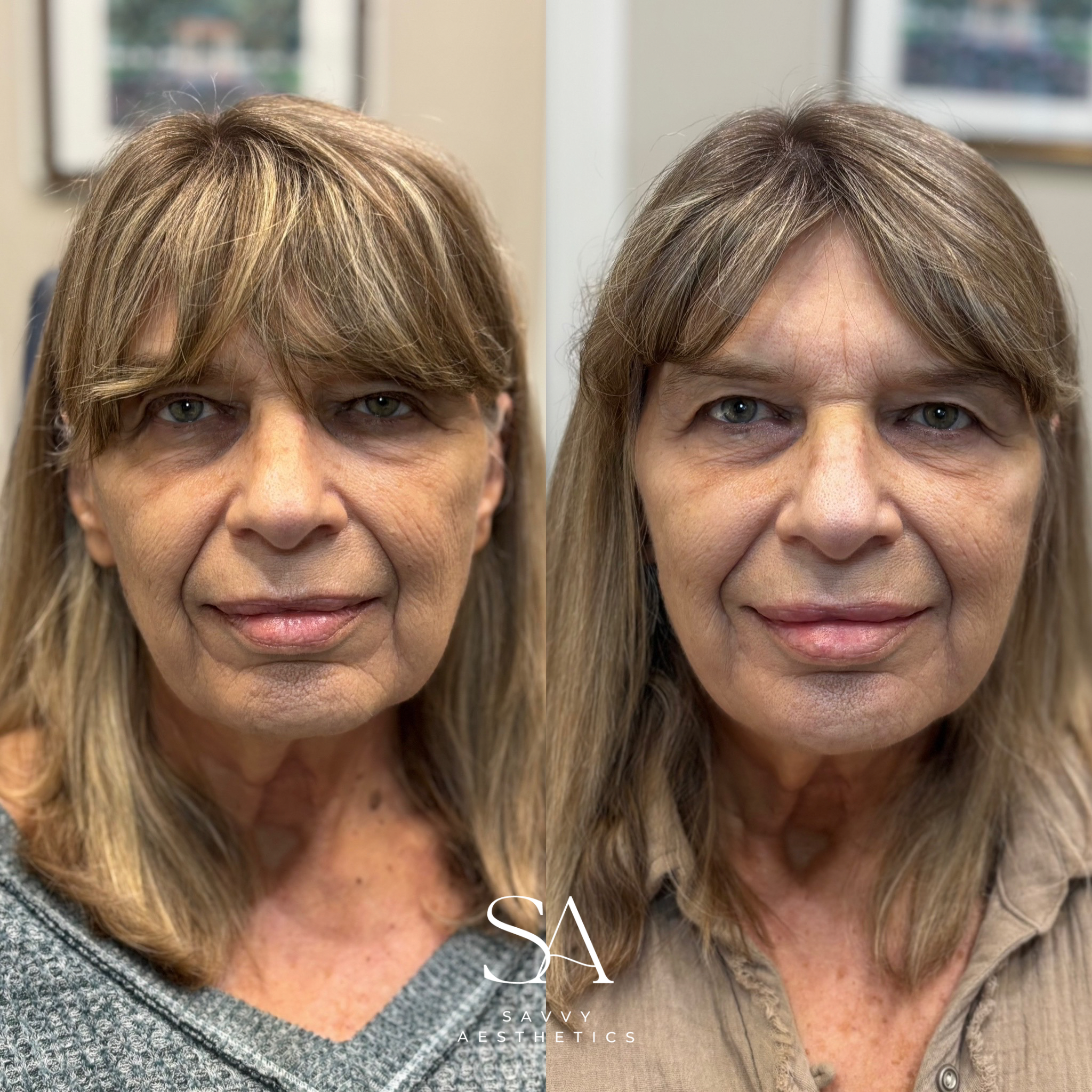 Before and after images of a woman showing facial improvements, including smoother skin and reduced wrinkles.