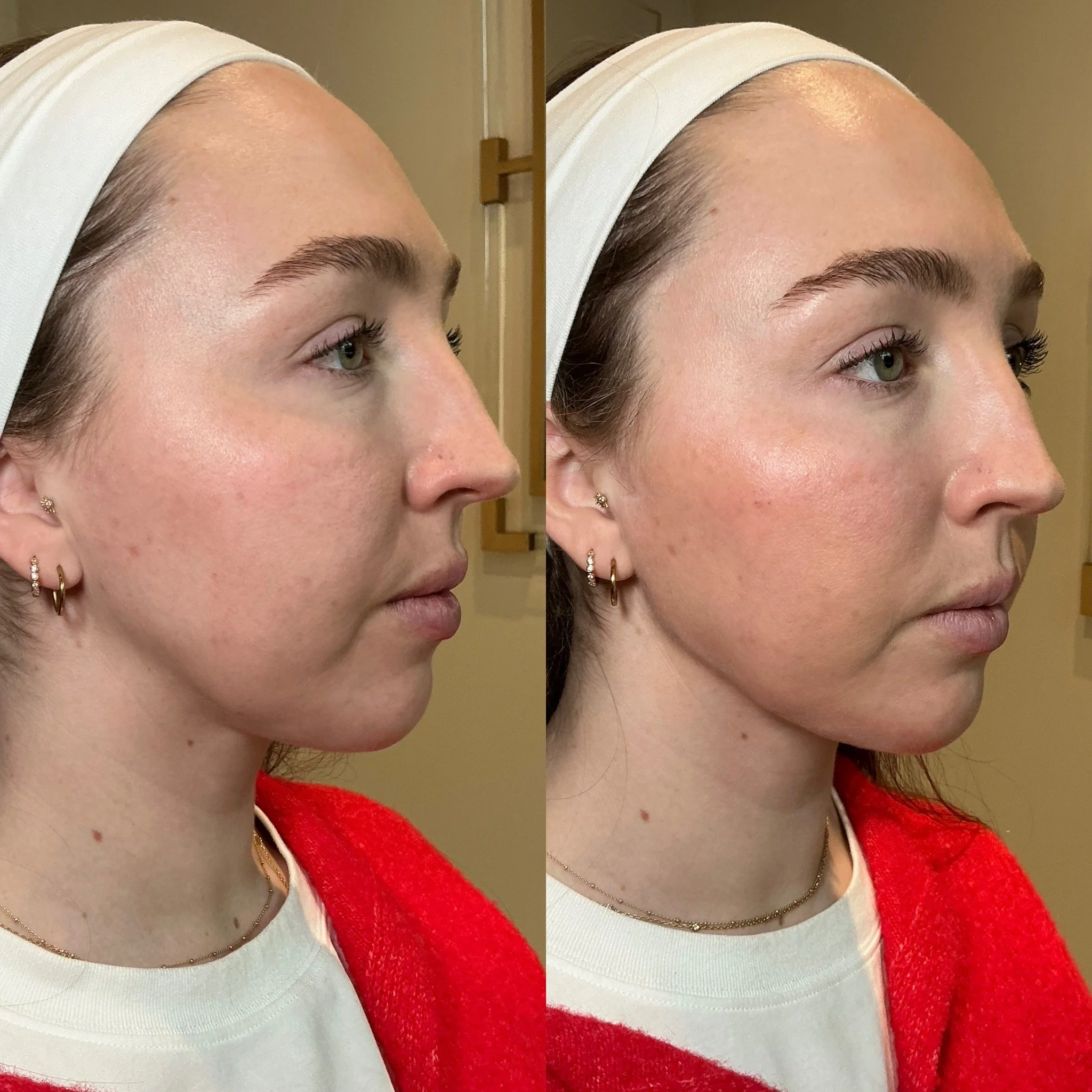 Side-by-side comparison of a woman with clear, smooth skin and minimal redness before and after skincare treatment, wearing a white headband, earrings, and a red garment.