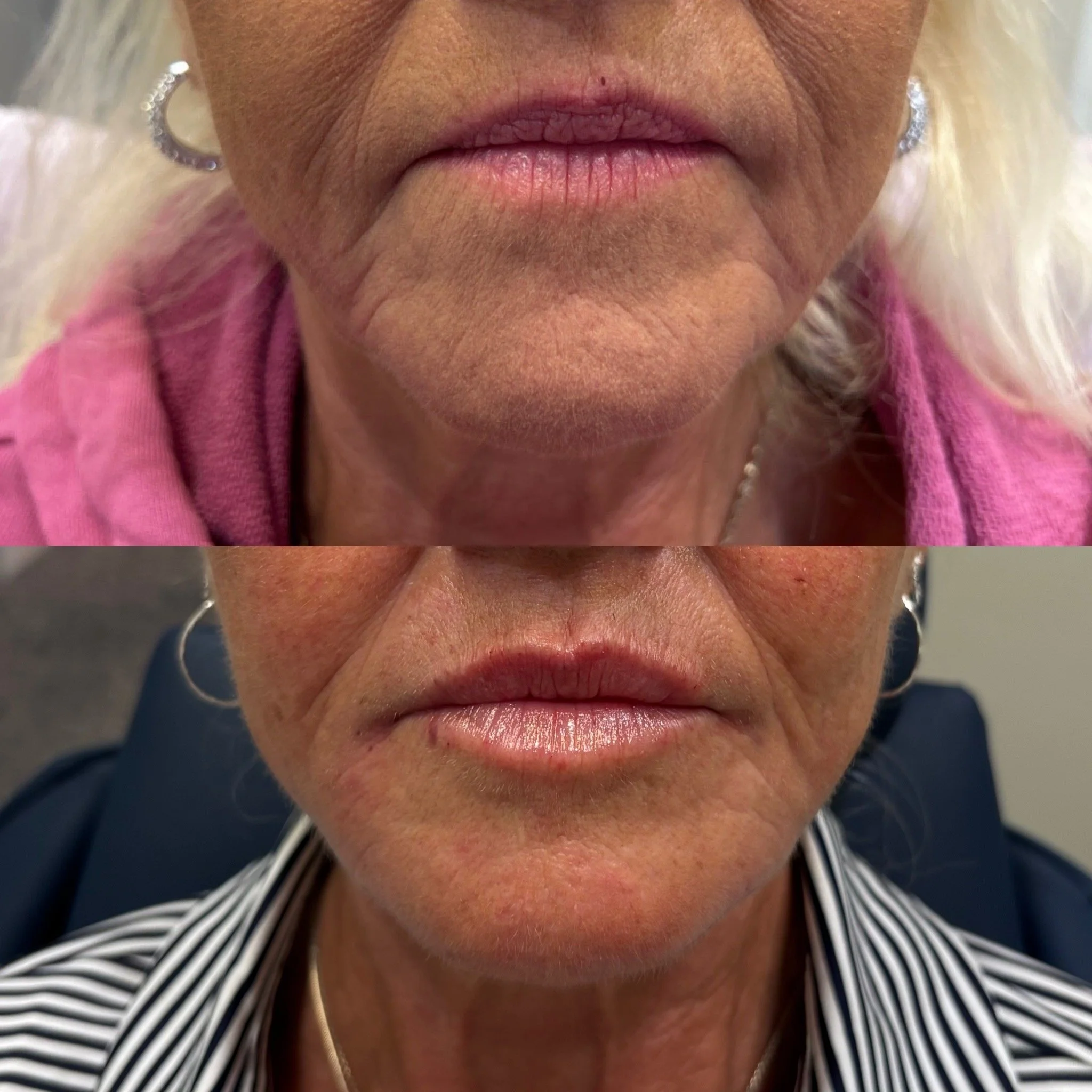 Close-up of a woman's lips before and after cosmetic lip enhancement.