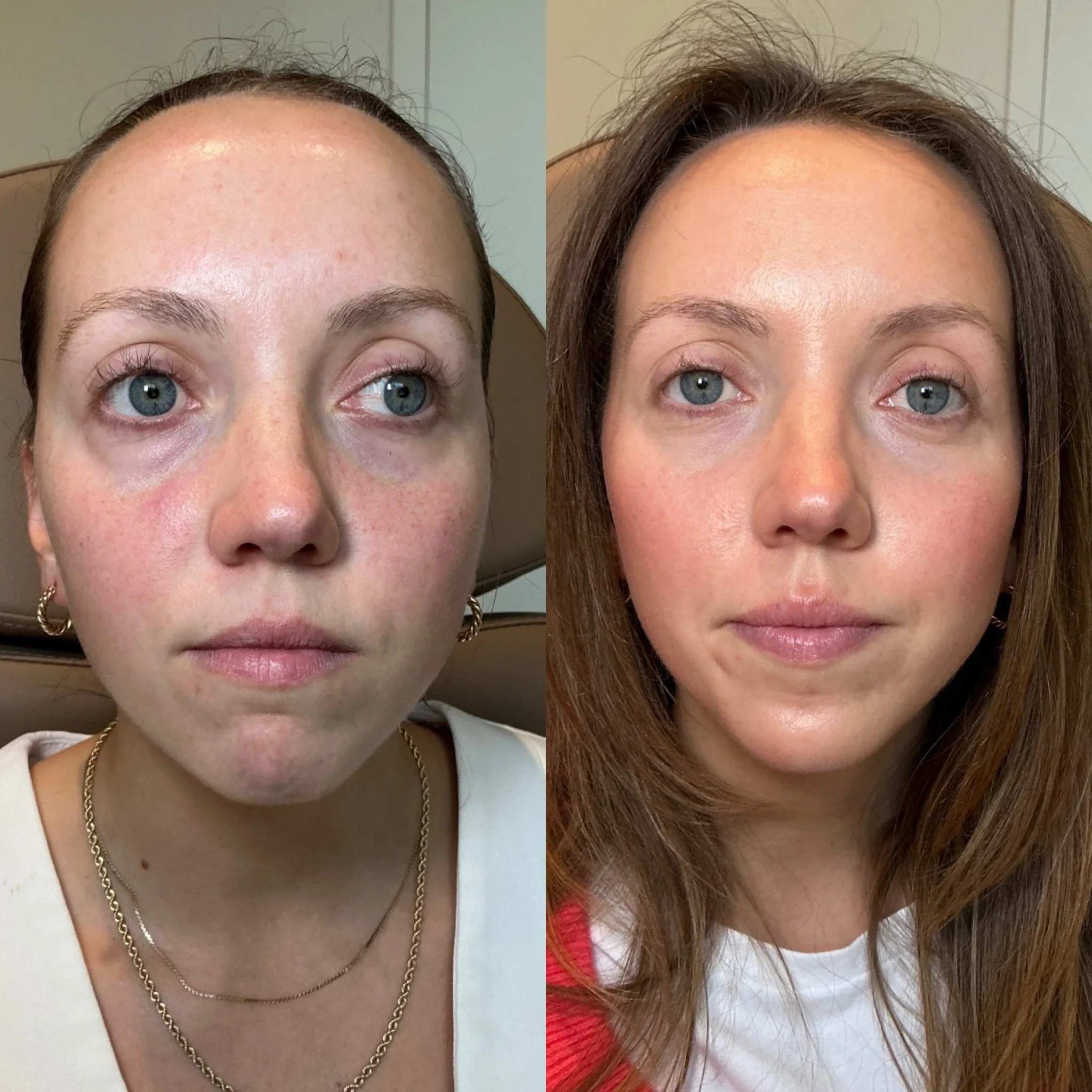 Side-by-side comparison of a woman before and after a skincare treatment, showing improved skin clarity, reduced redness, and a more even complexion.