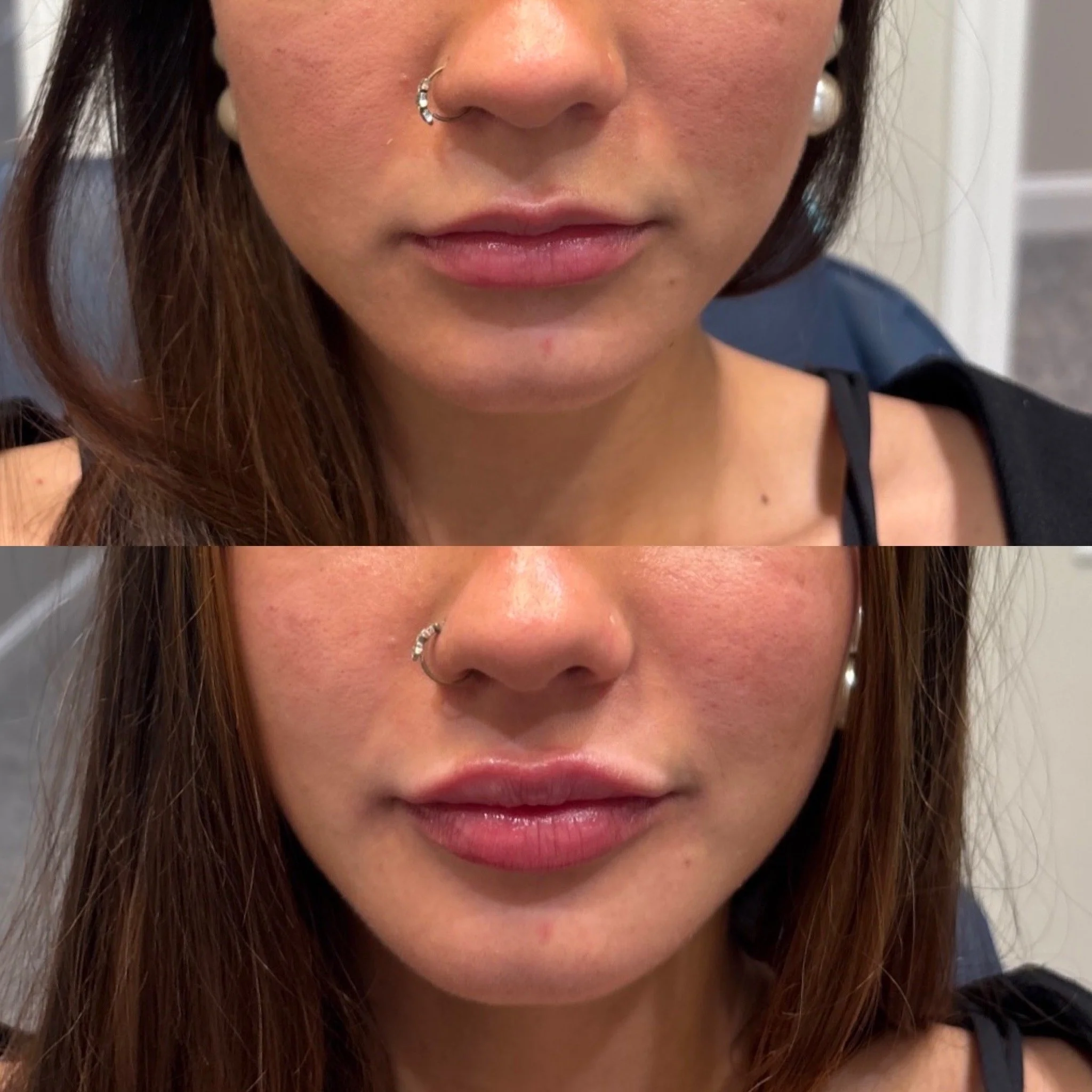 Close-up of a woman's face showing before and after images of lip enhancement, with the lower image showing fuller lips.