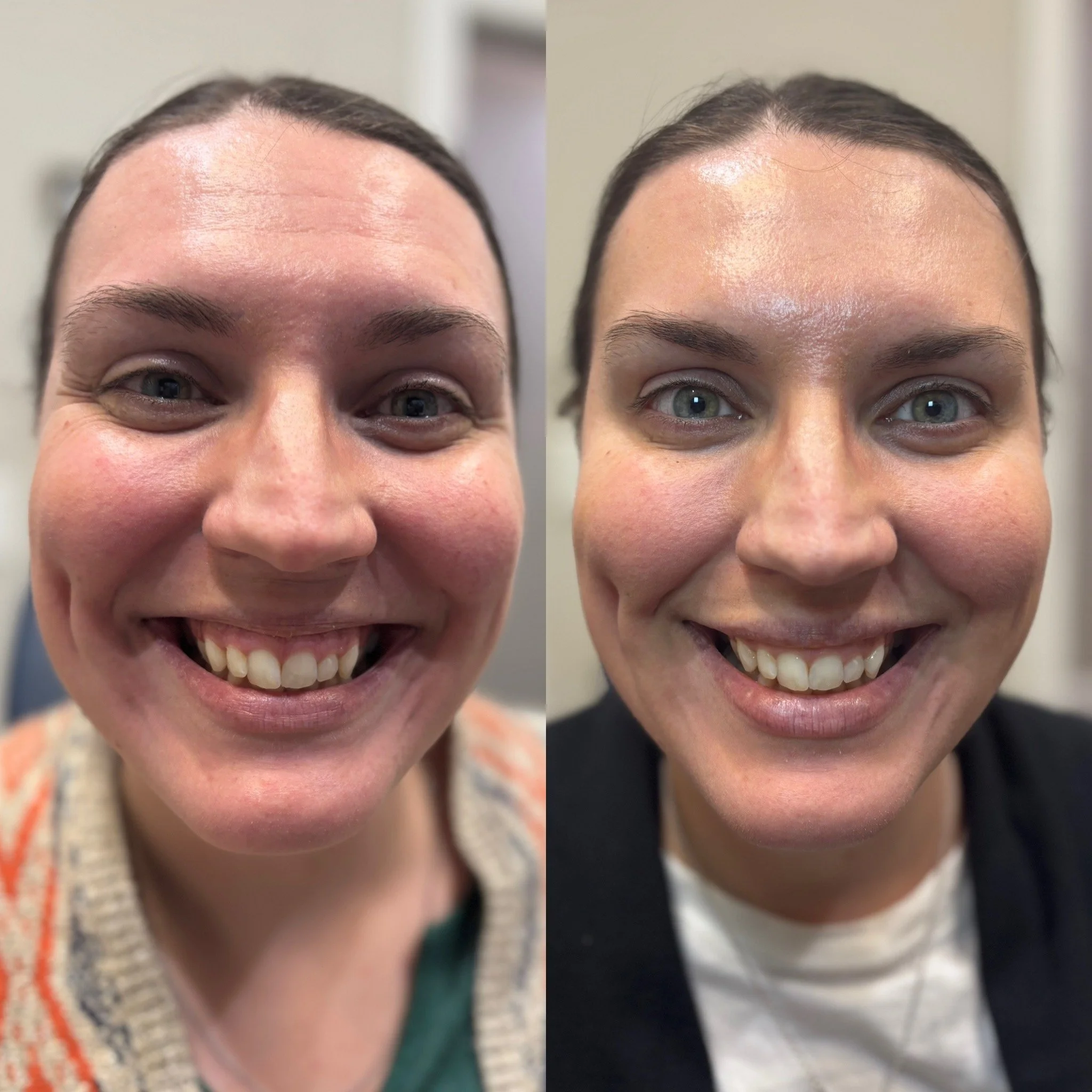 Side-by-side comparison of a woman before and after a skincare or cosmetic procedure, showing clear improvement in skin appearance and smile.