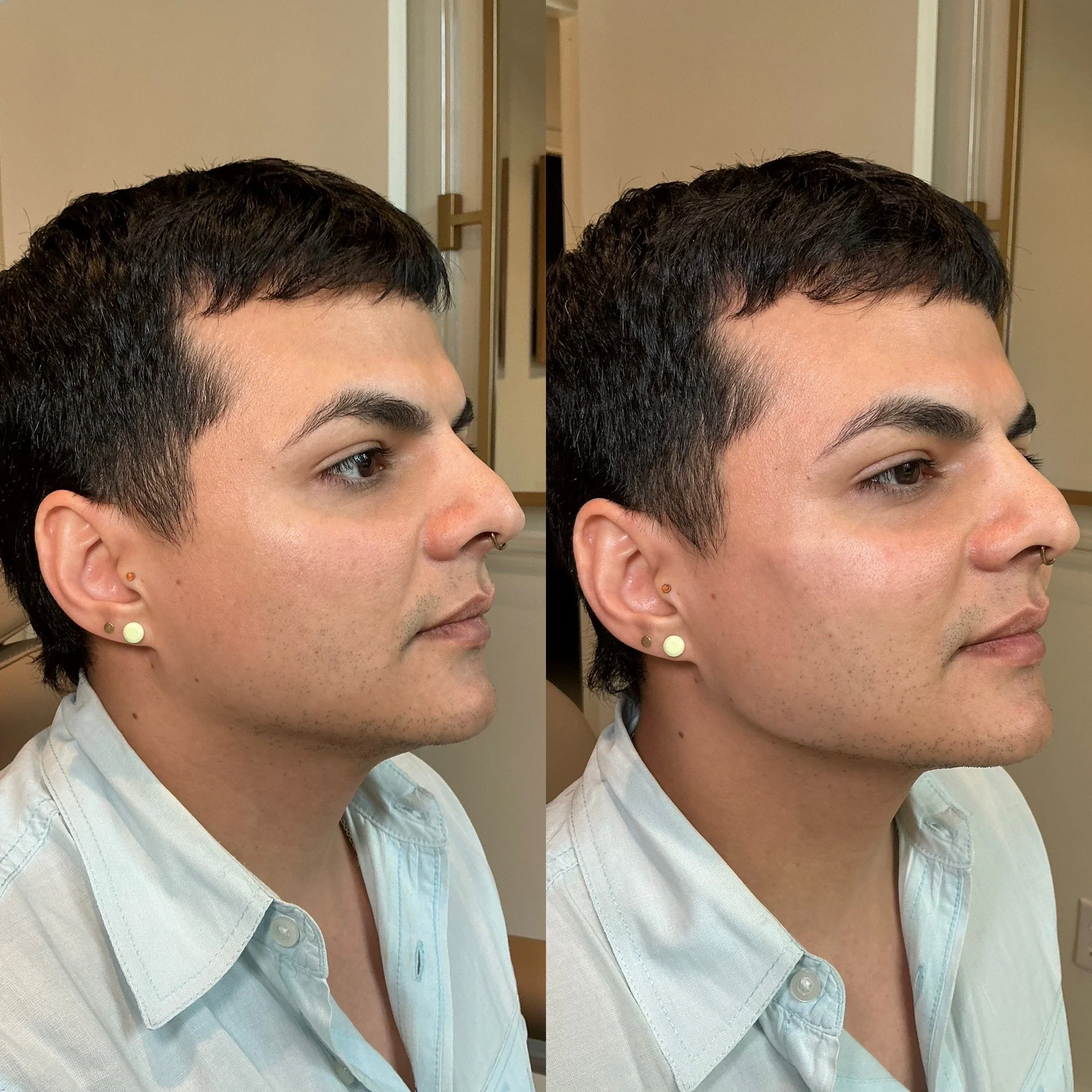 Side-by-side comparison of a man before and after a cosmetic procedure, showing improved skin texture and tone.