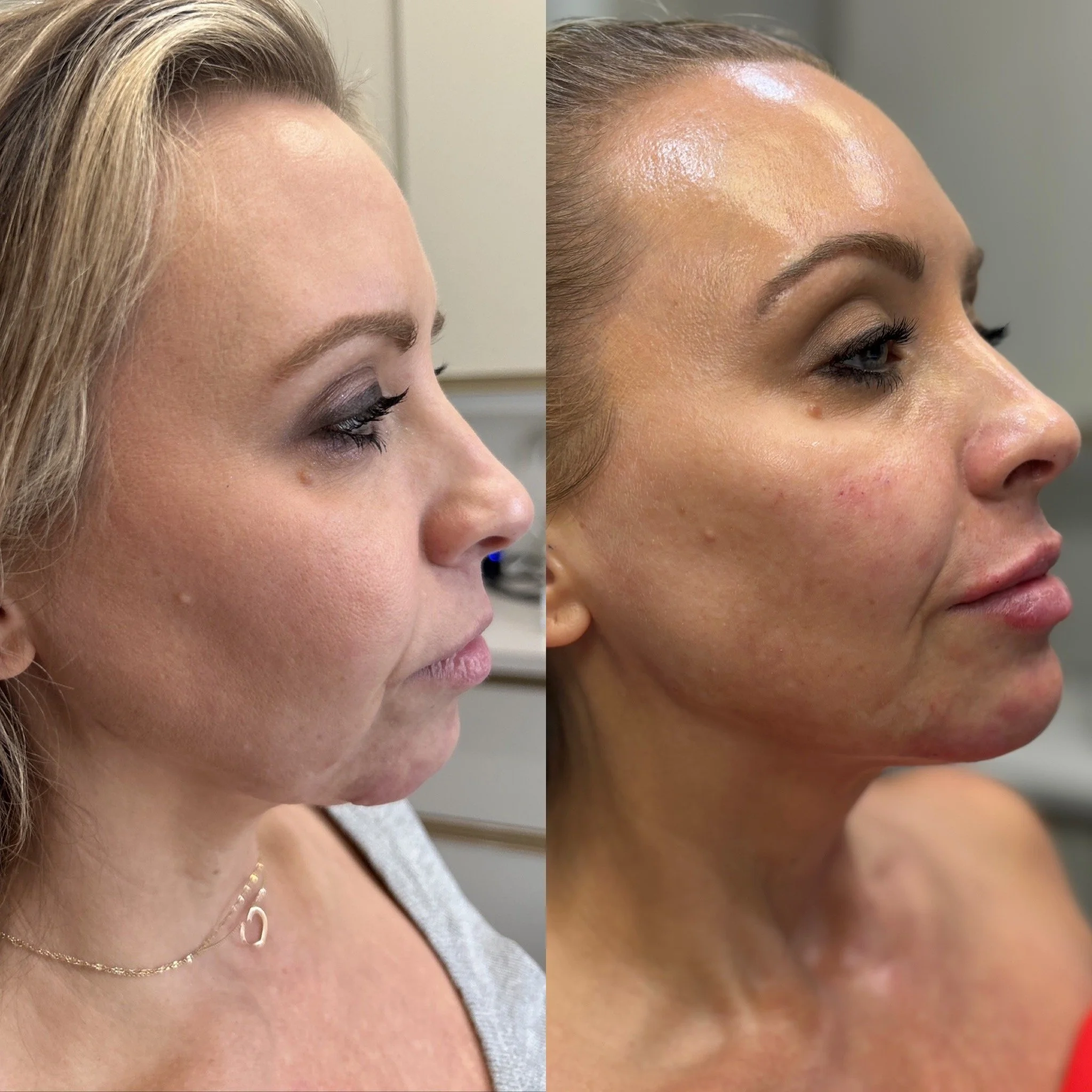 Side-by-side comparison of a woman's face before and after skincare treatment, showing improved skin texture and tone.
