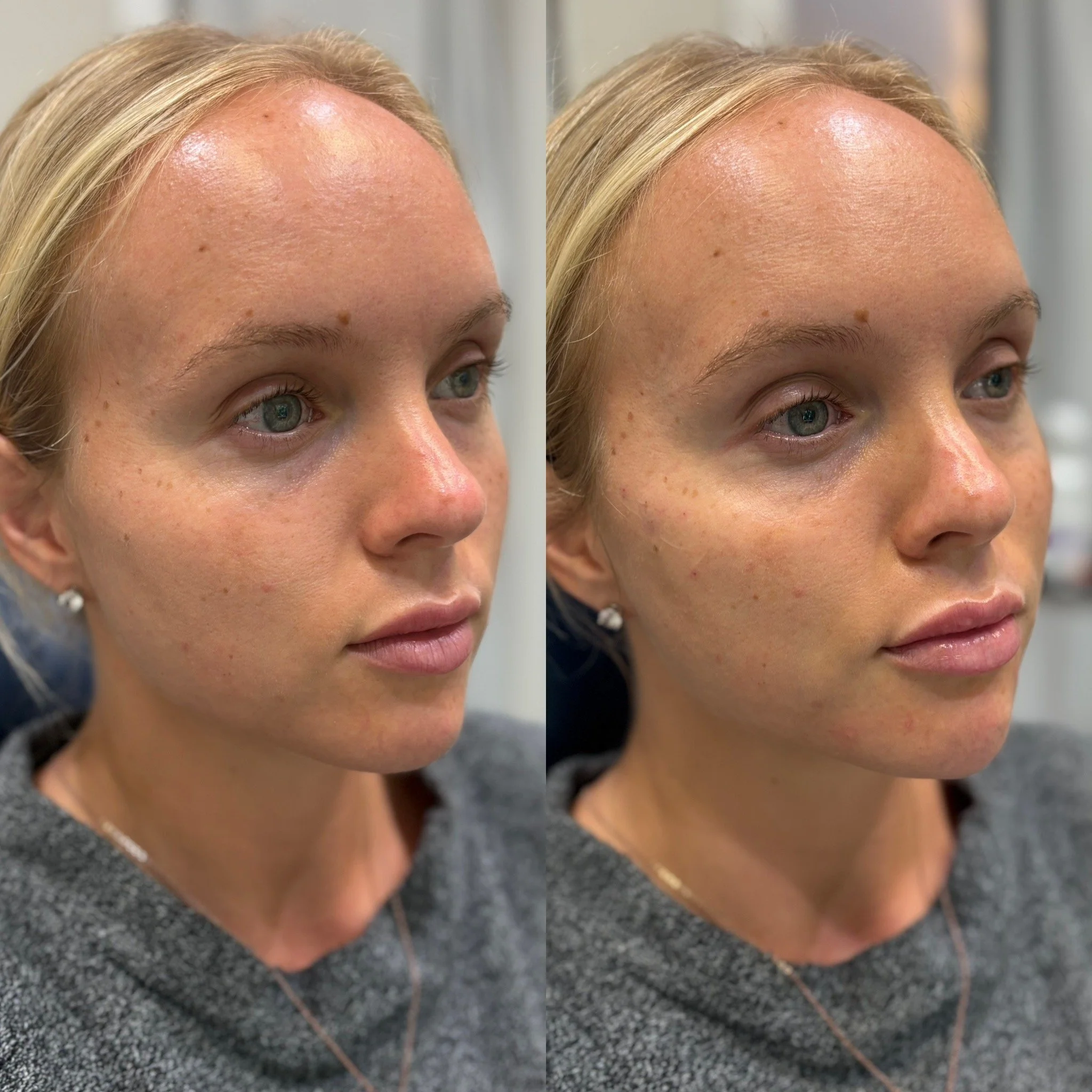 Side-by-side comparison photo of a woman before and after skincare treatment, showing improved skin texture and reduced redness.