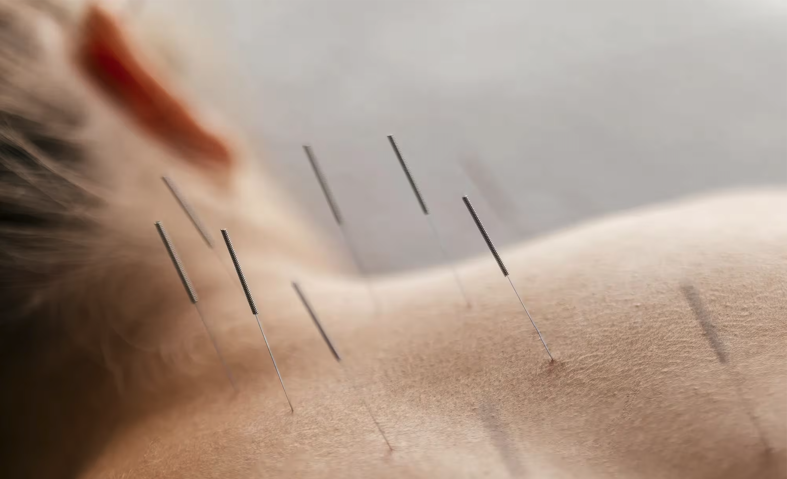 Close-up of acupuncture needles inserted into a person's skin.