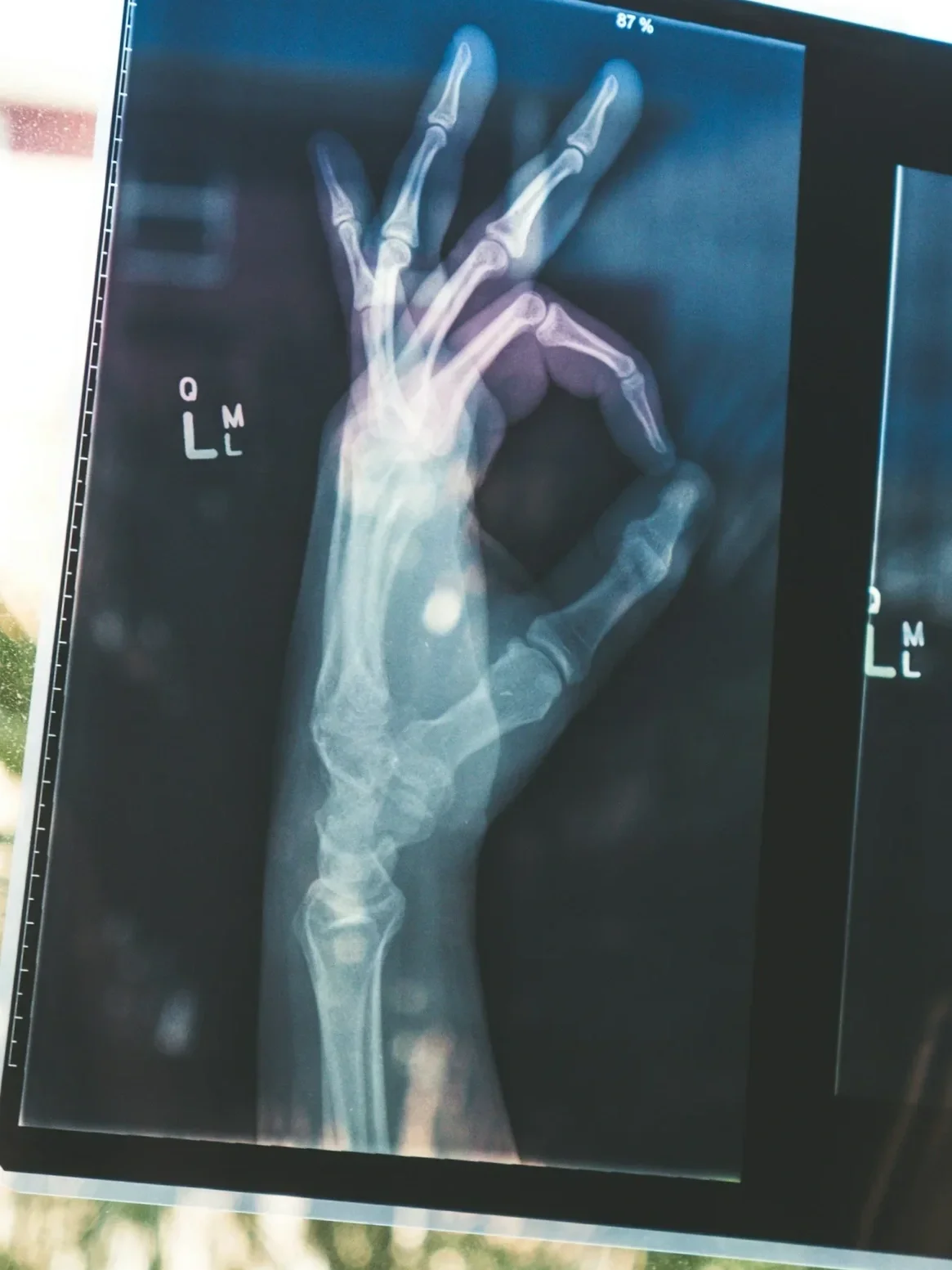 X-ray image of a left hand making the 'OK' gesture, showing bones and joints.