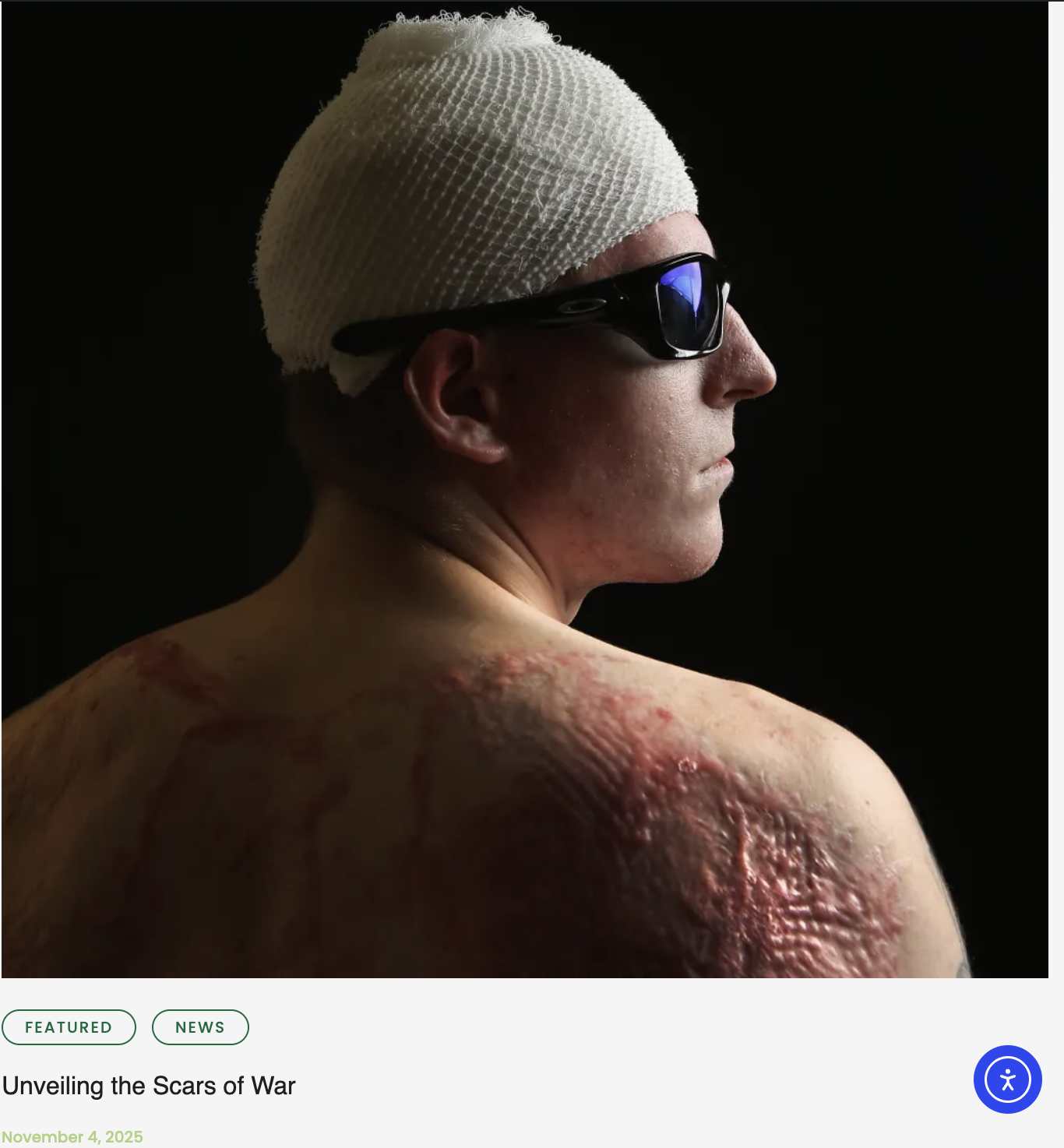 A person with a bandaged head, wearing sunglasses, and having burn scars on their shoulder and back, posed against a dark background.