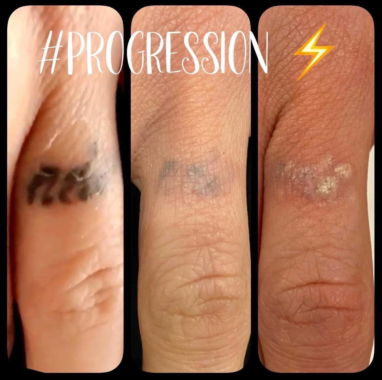 Progression of a fingernail healing from a fungal infection, showing three stages: an infected nail with black discoloration on the left, a partially recovered nail in the middle, and a healthier nail with minor residue on the right.